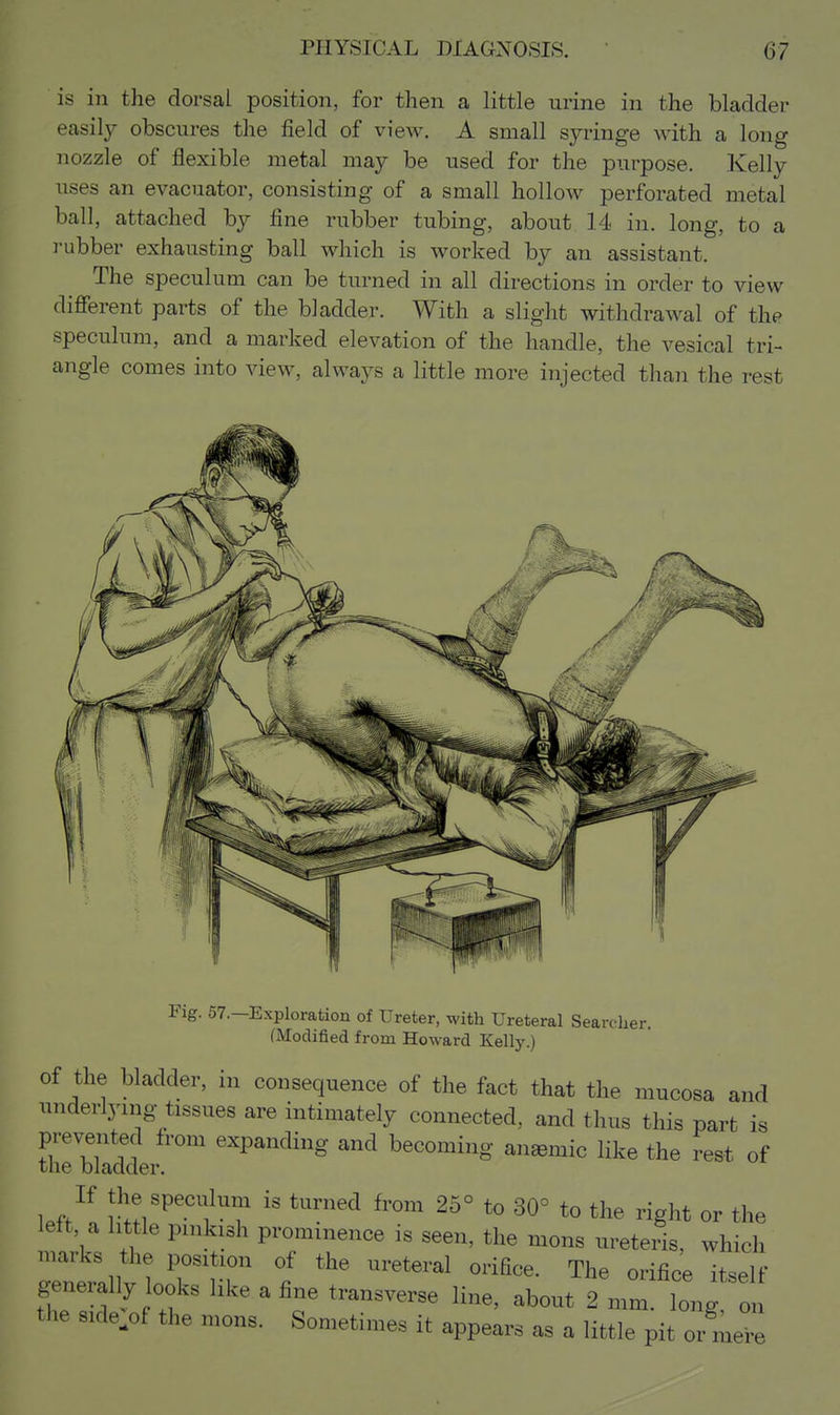 is in the dorsal position, for then a little urine in the bladder easily obscures the field of view. A small syringe with a long nozzle of flexible metal may be used for the purpose. Kelly uses an evacuator, consisting of a small hollow perforated metal ball, attached by fine rubber tubing, about 14 in. long, to a rubber exhausting ball which is worked by an assistant. The speculum can be turned in all directions in order to view different parts of the bladder. With a slight withdrawal of the speculum, and a marked elevation of the handle, the vesical tri- angle comes into view, always a little more injected than the rest Fig. 57.-Exploration of Ureter, with Ureteral Searcher. (Modified from Howard Kelly.) of the bladder, in consequence of the fact that the mucosa and underlying tissues are intimately connected, and thus this part is prevented from expanding and becoming anaemic like the rest of the bladder. If the speculum is turned from 25° to 30° to the right or the left, a little pinkish prominence is seen, the mons ureteiis, which marks the position of the ureteral orifice. The orifice itself generally looks like a fine transverse line, about 2 mm ong on the sKb of the mons. Sometimes it appears as a little pit or me'e