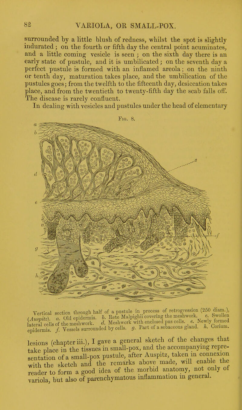 surrounded by a little blush of redness, whilst the spot is slightly indurated; on the fourth or fifth day the central point acuminates, and a little coming vesicle is seen ; on the sixth day there is an early state of pustule, and it is umbilicated; on the seventh day a perfect pustule is formed with an inflamed areola; on the ninth or tenth day, maturation takes place, and the umbilication of the pustules goes; from the twelfth to the fifteenth day, desiccation takes place, and from the twentieth to twenty-fifth day the scab falls off. The disease is rarely confluent. In dealing with vesicles and pustules under the head of elementary Fig. 8. Vertical section through half of a pustule m process of retrogression (250 diam. (AuZitz). a. Old epidermis. I. Eete Ma pighii covering the meshwork c. Swojen B ee Is of the meshwork. d. Meshwork with enclosed pus cells, e. Newly formed epidennb /• Vessels surrounded by cells, fif. Part of a sebaceous gland, h. Oonum. lesions (chapter iii.), I gave a general sketch of the changes that take place in the tissues in small-pox, and the accompanying repre- sentation of a small-pox pustule, after Auspitz taken in connexion with the sketch and the remarks above made, will enable the reader to form a good idea of the morbid anatomy, not only of variola but also of parenchymatous inflammation m general.