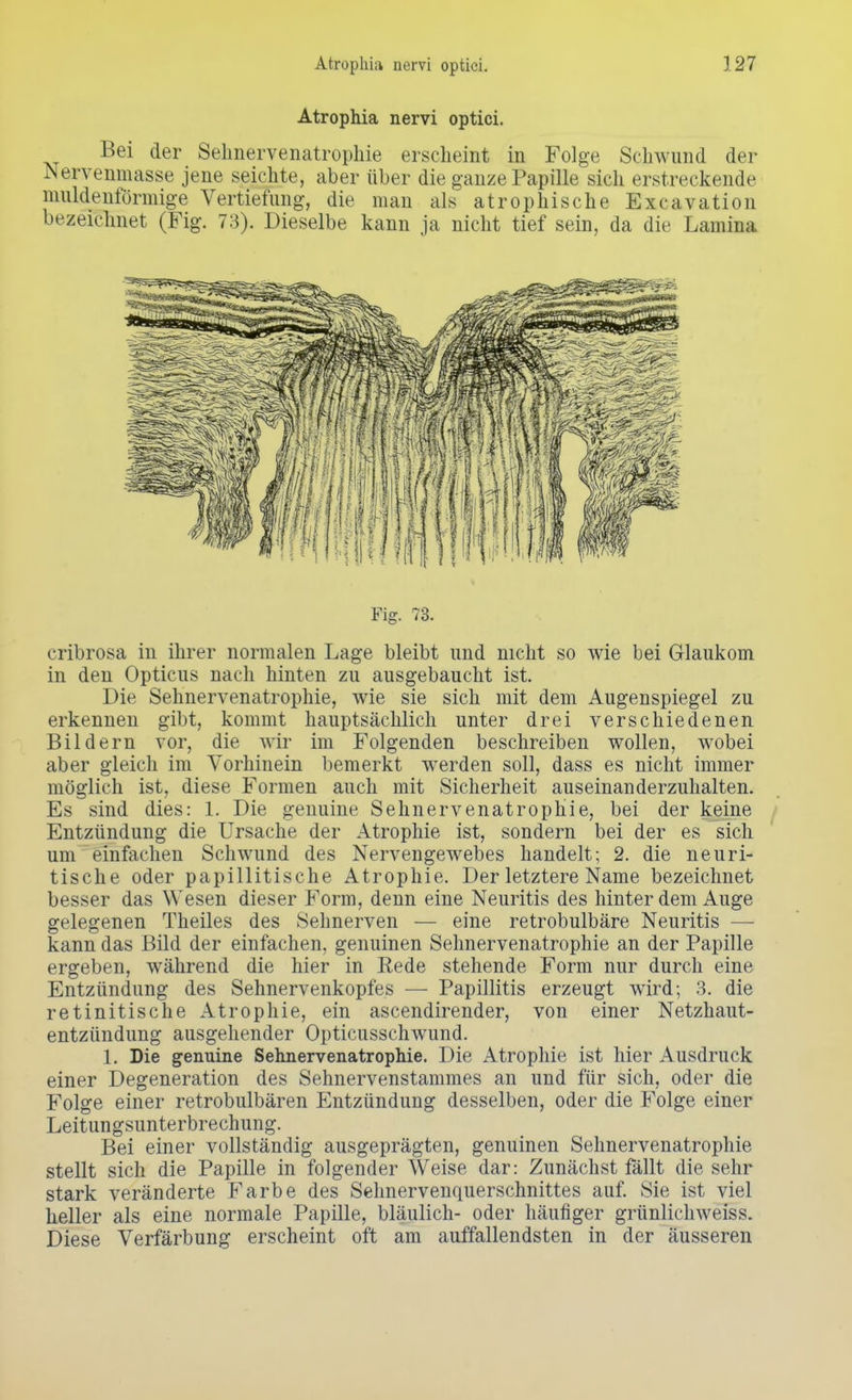 Atrophia nervi optici. Bei der Sebnervenatrophie erscheint in Folge Schwund der Nervemmisse jene seichte, aber über die ganze Papille sich erstreckende muldenförmige Vertiefung, die man als atrophische Excavation bezeichnet (Fig. 73). Dieselbe kann ja nicht tief sein, da die Lamina Fig. 73. eribrosa in ihrer normalen Lage bleibt und nicht so wie bei Glaukom in den Opticus nach hinten zu ausgebaucht ist. Die Sehnervenatrophie, wie sie sich mit dem Augenspiegel zu erkennen gibt, kommt hauptsächlich unter drei verschiedenen Bildern vor, die wir im Folgenden beschreiben wollen, wobei aber gleich im Vorhinein bemerkt werden soll, dass es nicht immer möglich ist, diese Formen auch mit Sicherheit auseinanderzuhalten. Es sind dies: 1. Die genuine Sehnervenatrophie, bei der keine Entzündung die Ursache der Atrophie ist, sondern bei der es sich um einfachen Schwund des Nervengewebes handelt; 2. die neuri- tische oder papillitische Atrophie. Der letztere Name bezeichnet besser das Wesen dieser Form, denn eine Neuritis des hinter dem Auge gelegenen Theiles des Sehnerven — eine retrobulbäre Neuritis — kann das Bild der einfachen, genuinen Sehnervenatrophie an der Papille ergeben, während die hier in Eede stehende Form nur durch eine Entzündung des Sehnervenkopfes — Papillitis erzeugt wird; 3. die retinitische Atrophie, ein ascendirender, von einer Netzhaut- entzündung ausgehender Opticusschwund. 1. Die genuine Sehnervenatrophie. Die Atrophie ist hier Ausdruck einer Degeneration des Sehnervenstammes an und für sich, oder die Folge einer retrobulbären Entzündung desselben, oder die Folge einer Leitungsunterbrechung. Bei einer vollständig ausgeprägten, genuinen Sehnervenatrophie stellt sich die Papille in folgender Weise dar: Zunächst fällt die sehr stark veränderte Farbe des Sehnervenquerschnittes auf. Sie ist viel heller als eine normale Papille, bläulich- oder häufiger grünlichweiss. Diese Verfärbung erscheint oft am auffallendsten in der äusseren