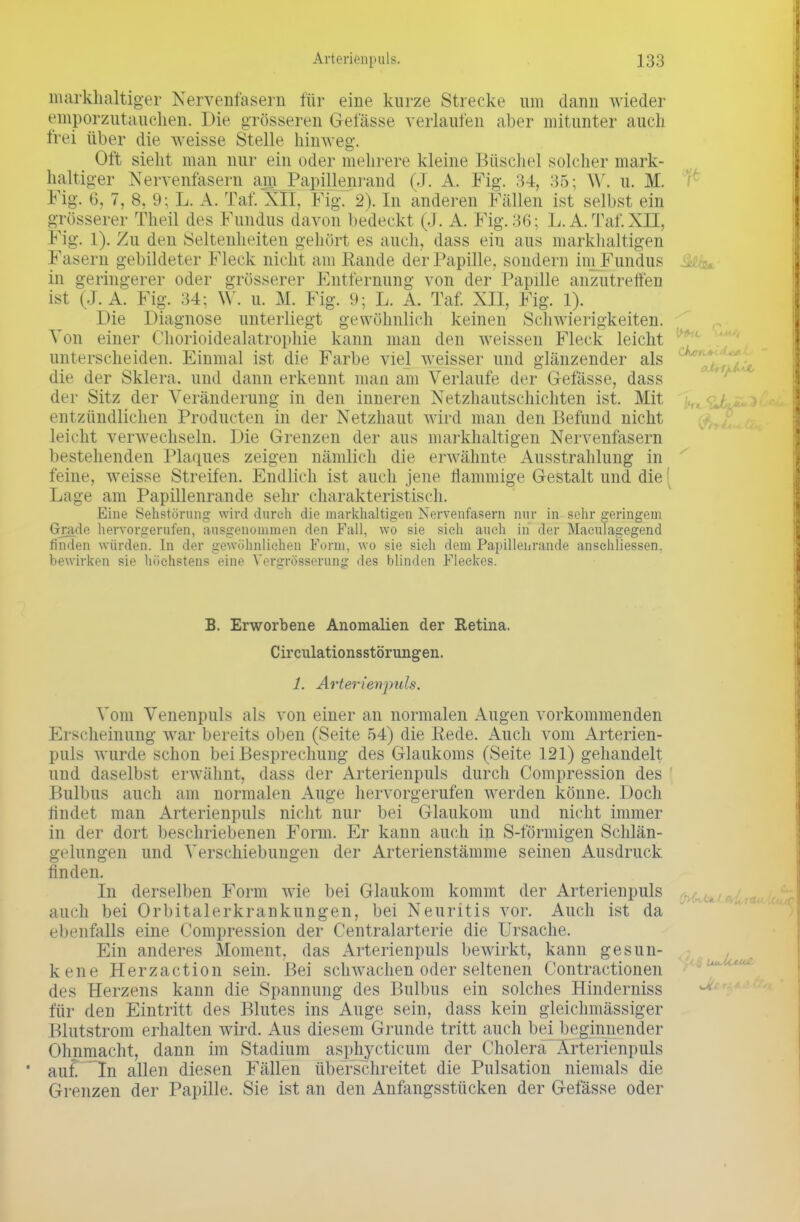 Arteriönpuls. markhaltiger Nervenfasern für eine kurze Strecke um dann wieder emporzutauchea. Die grösseren Gefässe verlaufen aber mitunter auch frei über die weisse Stelle hinweg. Oft sieht man nur ein oder mehrere kleine Büsche] solcher mark- haltiger Nervenfasern am Papillenrand (J. A. Fig. 34, 35; W. u. M. Fig. 6, 7, 8. 9; L. A. Taf. XII. Im- 2). In anderen Fällen ist selbst ein grösserer Theil des Fundus davon bedeckt (J. A. Fig. 36; L. A. Taf*. XII, Fig. 1). Zu den Seltenheiten gehört es auch, dass ein aus markhaltigen Fasern gebildeter Fleck nicht am Rande der Papille, sondern im Fundus & . in geringerer oder grösserer Entfernung von der Papille anzutreffen ist (-I. A. Fig. 34; W. u. M. Fig. 9; L. A. Tat'. XII. Fig. 1). Die Diagnose unterliegt gewöhnlich keinen Schwierigkeiten. Von einer Chorioidealatrophie kann man den weissen Fleck leicht unterscheiden. Einmal ist die Farbe viel weisser und glänzender als die der Sklera, und dann erkennt mau am Verlaufe der Gefässe, dass der Sitz der Veränderung in den inneren Netzhautschichten ist. Mit entzündlichen Producten in der Netzhaut wird man den Befund nicht leicht verwechseln. Die Grenzen der aus markhaltigen Nervenfasern bestehenden Plaques zeigen nämlich die erwähnte Ausstrahlung in feine, weisse Streifen. Endlich ist auch jene flaumige Gestalt und die Lage am Papillenrande sehr charakteristisch. Eine Sehstörung wird durch die markhaltigen Nervenfasern nur in sehr geringem Grade hervorgerufen, ausgenommen den Fall, wo sie sieh auch in der Maculagegend finden würden. In der gewöhnlichen Form, wo sie sieh dem Papillenrande anschliessen. bewirken sie höchstens eine Vergrösserung des blinden Fleckes. B. Erworbene Anomalien der Retina. Circulationsstörungen. 1. Arterienpuls. Vom Venenpuls als von einer an normalen Augen vorkommenden Erscheinung war bereits oben (Seite 54) die Rede. Auch vom Arterien- puls wurde schon bei Besprechung des Glaukoms (Seite 121) gehandelt und daselbst erwähnt, dass der Arterienpuls durch Compression des Bulbus auch am normalen Auge hervorgerufen werden könne. Doch findet man Arterienpuls nicht nur bei Glaukom und nicht immer in der dort beschriebenen Form. Er kann auch in S-förmigen Schlän- gelungen und Verschiebungen der Arterienstämme seinen Ausdruck linden. In derselben Form wie bei Glaukom kommt der Arterienpuls auch bei Orbitalerkrankungen, bei Neuritis vor. Auch ist da ebenfalls eine Compression der Centraiarterie die Ursache. Ein anderes Moment, das Arterienpuls bewirkt, kann gesun- kene Herzaction sein. Bei schwachen oder seltenen Contractionen des Herzens kann die Spannung des Bulbus ein solches Hinderniss für den Eintritt des Blutes ins Auge sein, dass kein gleichmässiger Blutstrom erhalten wird. Aus diesem Grunde tritt auch bei beginnender Ohnmacht, dann im Stadium asphyeticum der Cholera Arterienpuls au£ In allen diesen Fällen überschreitet die Pulsation niemals die Grenzen der Papille. Sie ist an den Anfangsstücken der Gefässe oder