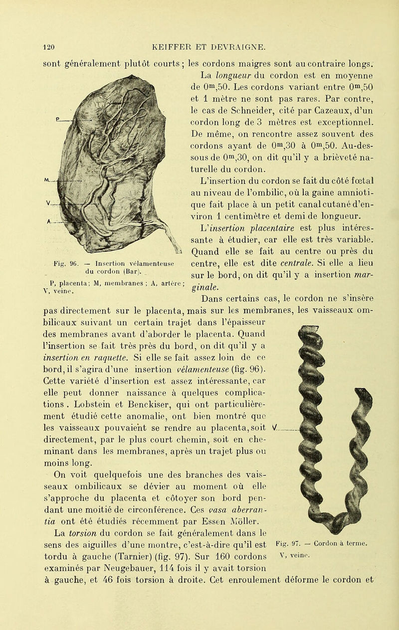 Fig, 9G. — Insertion vélamenteuse du cordon (Bar). P, placenta; M, membranes ; A, artère; V, veine. sont généralement plutôt courts; les cordons maigres sont au contraire longs. La longueur du cordon est en moyenne de 0m,50. Les cordons variant entre 0m,50 et 1 mètre ne sont pas rares. Par contre, le cas de Schneider, cité par Cazeaux, d'un cordon long de 3 mètres est exceptionnel. De même, on rencontre assez souvent des cordons ayant de 0m,30 à 0m,50. Au-des- sous de 0m,30, on dit qu'il y a brièveté na- turelle du cordon. L'insertion du cordon se fait du côté fœtal au niveau de l'ombilic, où la gaine amnioti- que fait place à un petit canal cutané d'en- viron 1 centimètre et demi de longueur. L'insertion placentaire est plus intéres- sante à étudier, car elle est très variable. Quand elle se fait au centre ou près du centre, elle est dite centrale. Si elle a lieu sur le bord, on dit qu'il y a insertion mar- ginale. Dans certains cas, le cordon ne s'insère pas directement sur le placenta, mais sur les membranes, les vaisseaux om- bilicaux suivant un certain trajet dans l'épaisseur des membranes avant d'aborder le placenta. Quand l'insertion se fait très près du bord, on dit qu'il y a insertion en raquette. Si elle se fait assez loin de ce bord, il s'agira d'une insertion vélamenteuse (fig. 96). Cette variété d'insertion est assez intéressante, car elle peut donner naissance à quelques complica- tions . Lobstein et Benckiser, qui ont particulière- ment étudié cette anomalie, ont bien montré que les vaisseaux pouvaient se rendre au placenta, soit directement, par le plus court chemin, soit en che- minant dans les membranes, après un trajet plus ou moins long. On voit quelquefois une des branches des vais- seaux ombilicaux se dévier au moment où elle s'approche du placenta et côtoyer son bord pen- dant une moitié de circonférence. Ces çasa aberran- tia ont été étudiés récemment par Essen Môller. La torsion du cordon se fait généralement dans le sens des aiguilles d'une montre, c'est-à-dire qu'il est tordu à gauche (Tarnier) (fig. 97). Sur 160 cordons examinés par Neugebauer, 114 fois il y avait torsion à gauche, et 46 fois torsion à droite. Cet enroulement déforme le cordon et Fig. 97. — Cordon à terme. V, veine.