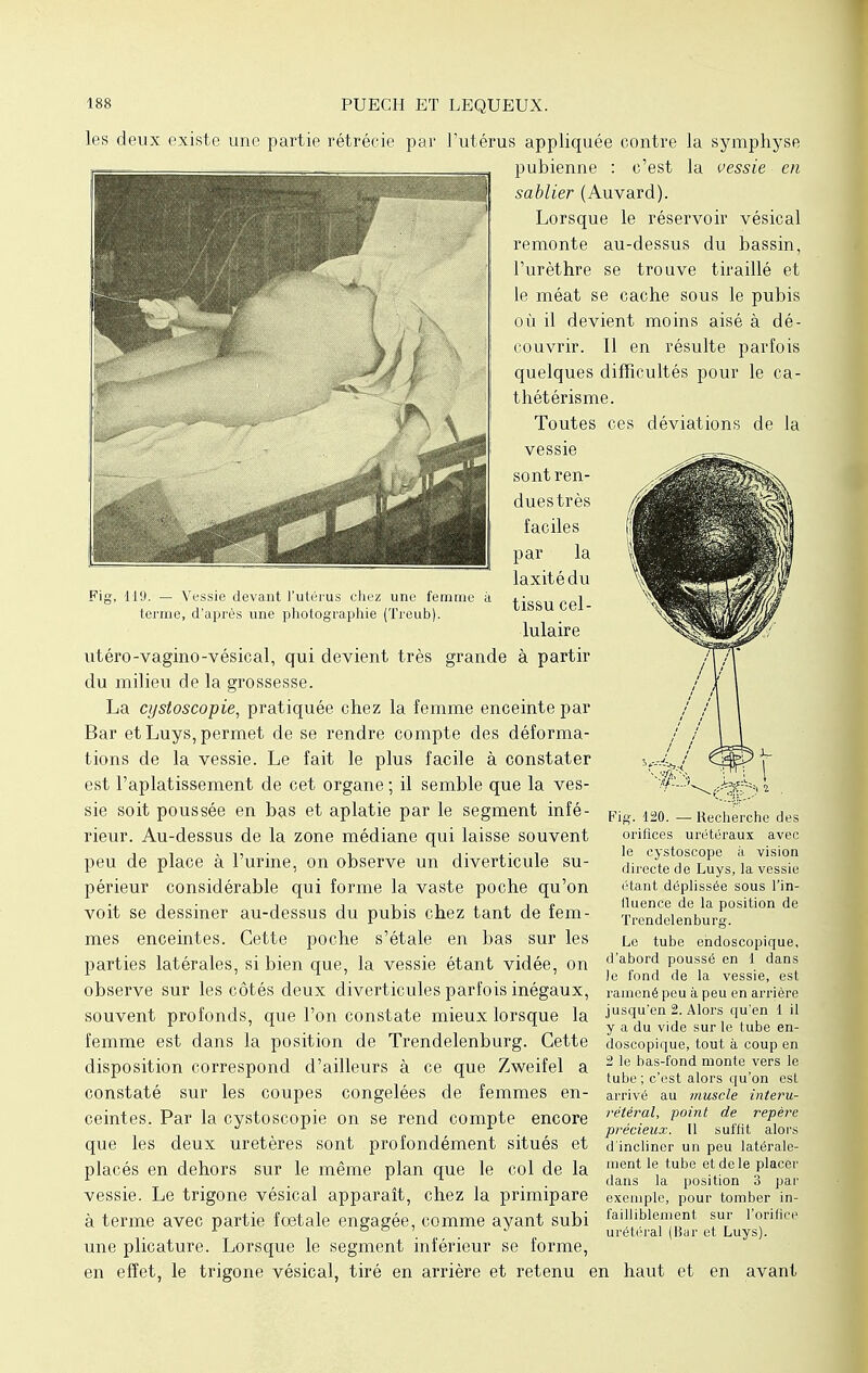 Fig, 119. — Vessie devant l'utérus chez une femme à terme, d'après une photographie (Treub). les deux existe une partie rétrécie par l'utérus appliquée contre la symphyse pubienne : c'est la vessie en sablier (Auvard). Lorsque le réservoir vésical remonte au-dessus du bassin, Purèthre se trouve tiraillé et le méat se cache sous le pubis où il devient moins aisé à dé- couvrir. Il en résulte parfois quelques difficultés pour le ca- thétérisme. Toutes ces déviations de la vessie sont ren- dues très faciles par la laxitédu tissu cel- lulaire utéro-vagino-vésical, qui devient très grande à partir du milieu de la grossesse. La cystoscopie, pratiquée chez la femme enceinte par Bar et Luys, permet de se rendre compte des déforma- tions de la vessie. Le fait le plus facile à constater est l'aplatissement de cet organe ; il semble que la ves- sie soit poussée en bas et aplatie par le segment infé- rieur. Au-dessus de la zone médiane qui laisse souvent peu de place à l'urine, on observe un diverticule su- périeur considérable qui forme la vaste poche qu'on voit se dessiner au-dessus du pubis chez tant de fem- mes enceintes. Cette poche s'étale en bas sur les parties latérales, si bien que, la vessie étant vidée, on ,d aborc| poussé en i dans 1 . . Je fond de la vessie, est Observe Sur les CÔtés deux diverticules parfois inégaux, ramené peu à peu en arrière souvent profonds, que l'on constate mieux lorsque la Jusqu'en 2. Alors quen i il x 11 1 y a du vide sur le tube en- femme est dans la position de Trendelenburg. Cette doscopique, tout à coup en disposition correspond d'ailleurs à ce que Zweifel a 2 >e bas-fond monte vers le 1 tube ; c est alors qu on est constaté sur les coupes congelées de femmes en- arrivé au muscle interu- ceintes. Par la cystoscopie on se rend compte encore reter(l1^ P011^1 de repère . précieux. Il suint alors que les deux uretères sont profondément situés et d'incliner un peu îatéraie- placés en dehors sur le même plan que le col de la '«ent le tube et de le placer r 1 1 dans la position 3 par vessie. Le trigone vésical apparaît, chez la primipare exemple, pour tomber in- à terme avec partie fœtale engagée, comme ayant subi faiblement sur l'orifice r 001^ j uréteral (Bar et Luys). une plicature. Lorsque le segment inférieur se forme, en effet, le trigone vésical, tiré en arrière et retenu en haut et en avant Fig. 120. — Recherche des orifices urétéraux avec le eystoscope à vision directe de Luys, la vessie étant déplissée sous l'in- fluence de la position de Trendelenburg. Le tube endoscopique.