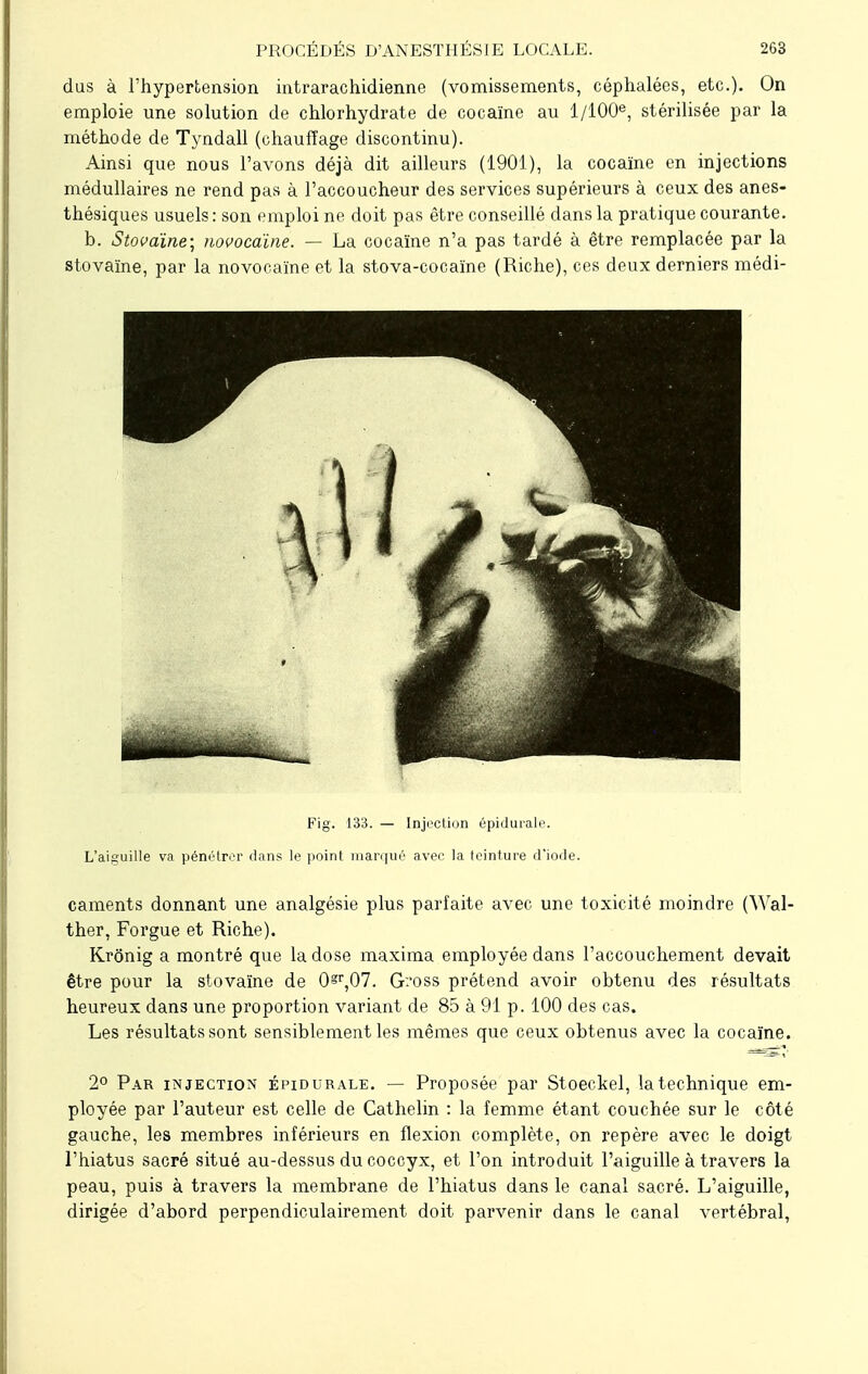 dus à l'hypertension intrarachidienne (vomissements, céphalées, etc.). On emploie une solution de chlorhydrate de cocaïne au l/100e, stérilisée par la méthode de Tyndall (chauffage discontinu). Ainsi que nous l'avons déjà dit ailleurs (1901), la cocaïne en injections médullaires ne rend pas à l'accoucheur des services supérieurs à ceux des anes- thésiques usuels : son emploi ne doit pas être conseillé dans la pratique courante. b. Stovaïne; novocaïne. — La cocaïne n'a pas tardé à être remplacée par la stovaïne, par la novocaïne et la stova-cocaïne (Riche), ces deux derniers médi- Fig. 133. — Injection épidurale. L'aiguille va pénétrer dans le point marqué avec la teinture d'iode. caments donnant une analgésie plus parfaite avec une toxicité moindre (Wal- ther, Forgue et Riche). Krônig a montré que la dose maxima employée dans l'accouchement devait être pour la stovaïne de 0=r,07. Gx>ss prétend avoir obtenu des résultats heureux dans une proportion variant de 85 à 91 p. 100 des cas. Les résultats sont sensiblement les mêmes que ceux obtenus avec la cocaïne. 2° Par injection épidurale. — Proposée par Stoeckel, la technique em- ployée par l'auteur est celle de Cathelin : la femme étant couchée sur le côté gauche, les membres inférieurs en flexion complète, on repère avec le doigt l'hiatus sacré situé au-dessus du coccyx, et l'on introduit l'aiguille à travers la peau, puis à travers la membrane de l'hiatus dans le canal sacré. L'aiguille, dirigée d'abord perpendiculairement doit parvenir dans le canal vertébral,