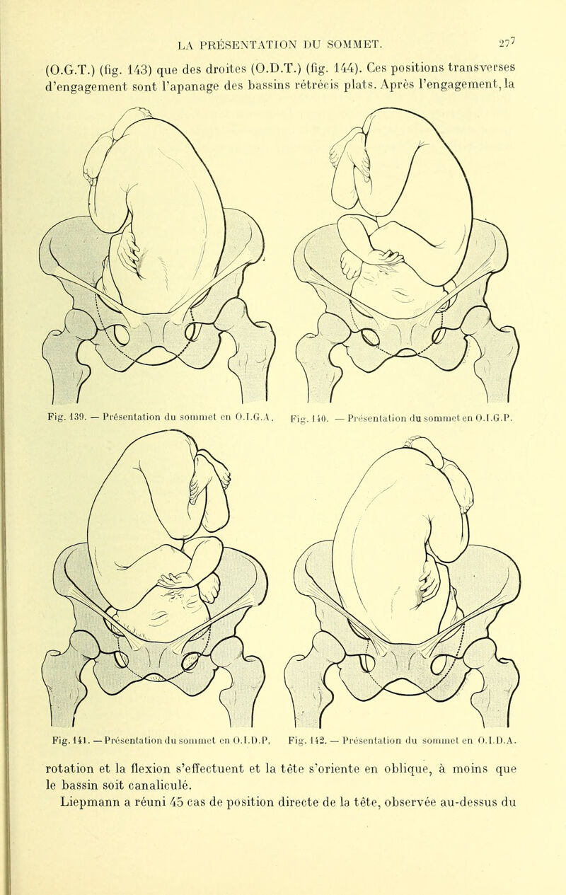 LA PRÉSENTATION DU SOMMET. 27? (O.G.T.) (fig. 143) que des droites (O.D.T.) (fig. 144). Ces positions transverses d'engagement sont l'apanage des bassins rétrécis plats. Après l'engagement, la Fig. 139. — Présentation du sommet en O.I.G.A. Fig. no. _ Présentation du sommet en O.I.G.P. rotation et la flexion s'effectuent et la tête s'oriente en oblique, à moins que le bassin soit canaliculé. Liepmann a réuni 45 cas de position directe de la tète, observée au-dessus du