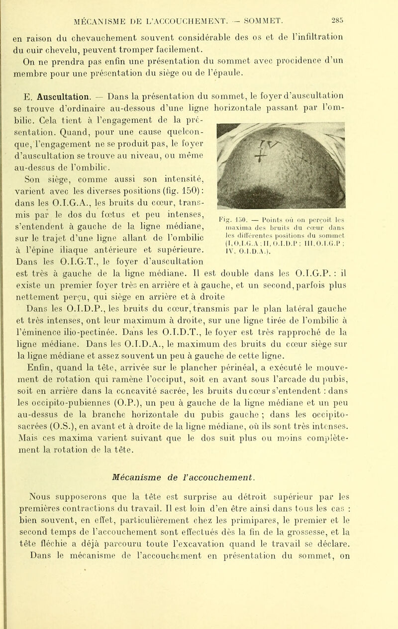 en raison du chevauchement souvent considérable des os et de l'infiltration du cuir chevelu, peuvent tromper facilement. On ne prendra pas enfin une présentation du sommet avec procidence d'un membre pour une présentation du siège ou de l'épaule. E. Auscultation. — Dans la présentation du sommet, le foyer d'auscultation se trouve d'ordinaire au-dessous d'une ligne horizontale passant par l'om- bilic. Cela tient à l'engagement de la pré- sentation. Quand, pour une cause quelcon- que, l'engagement ne se produit pas, le foyer d'auscultation se trouve au niveau, ou même au-dessus de l'ombilic. Son siège, comme aussi son intensité, varient avec les diverses positions (fig. 150): dans les O.I.G.A., les bruits du cœur, trans- mis par le dos du fœtus et peu intenses 1 1< ig. loO. — l'oints ou on perron. les s'entendent à gauche de la ligne médiane, maxima des bruits du finir dans sur le trajet d'une ligne allant de l'ombilic [f0djff|^fj° d?™ hViTp' à l'épine iliaque antérieure et supérieure. iv, b.i.D.À.).' Dans les O.I.G.T., le foyer d'auscultation est très à gauche de la ligne médiane. Il est double dans les O.I.G.P. : il existe un premier foyer très en arrière et à gauche, et un second, parfois plus nettement perçu, qui siège en arrière et à droite Dans les O.I.D.P., les bruits du cœur, transmis par le plan latéral gauche et très intenses, ont leur maximum à droite, sur une ligne tirée de l'ombilic à l'éminence ilio-pectinée. Dans les O.I.D.T., le foyer est très rapproché de la ligne médiane. Dans les O.I.D.A., le maximum des bruits du cœur siège sur la ligne médiane et assez souvent un peu à gauche de cette ligne. Enfin, quand la tête, arrivée sur le plancher périnéal, a exécuté le mouve- ment de rotation qui ramène l'occiput, soit en avant sous l'arcade du pubis, soit en arrière dans la concavité sacrée, les bruits du cœur s'entendent : dans les occipito-pubiennes (O.P.), un peu à gauche de la ligne médiane et un peu au-dessus de la branche horizontale du pubis gauche ; dans les occipito- sacrées (O.S.), en avant et à droite de la ligne médiane, où ils sont très intenses. Mais ces maxima varient suivant que le dos suit plus ou moins complète- ment la rotation de la tête. Mécanisme de l'accouchement. Nous supposerons que la tête est surprise au détroit supérieur par les premières contractions du travail. Il est loin d'en être ainsi dans tous les cas : bien souvent, en effet, particulièrement chez les primipares, le premier et le second temps de l'accouchement sont effectués dès la fin de la grossesse, et la tête fléchie a déjà parcouru toute l'excavation quand le travail se déclare. Dans le mécanisme de l'accouchement en présentation du sommet, on