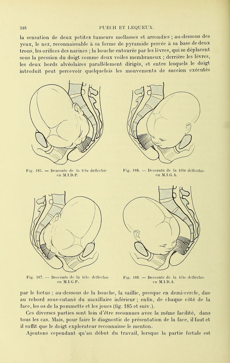 la sensation de deux petites tumeurs mollasses et arrondies ; au-dessous des yeux, le nez, reconnaissable à sa forme de pyramide percée à sa base de deux trous, les orifices des narines ; la bouche entourée par les lèvres, qui se déplacent sous la pression du doigt comme deux voiles membraneux ; derrière les lèvres, les deux bords alvéolaires parallèlement dirigés, et entre lesquels le doigt introduit peut percevoir quelquefois les mouvements de succion exécutés Fig. 18o. — Descente de la tète délléchic Fig. 186. — Descente de la tète défléchie en M.I.D.P. en M.I.G.A. Fig. 187. — Descente de la lètc défléchie Fig. 188. — Descente de la tète délléchic en M.I.G.P. en M.I.D.A. par le fœtus ; au-dessous de la bouche, la saillie, presque en demi-cercle, due au rebord sous-cutané du maxillaire inférieur ; enfin, de chaque côté de la face, les os de la pommette et les joues (fig. 185 et suiv.). Ces diverses parties sont loin d'être reconnues avec la même facilité, dans tous les cas. Mais, pour faire le diagnostic de présentation de la face, il faut et il suffit que le doigt explorateur reconnaisse le menton. Ajoutons cependant qu'au début du travail, lorsque la partie foetale est