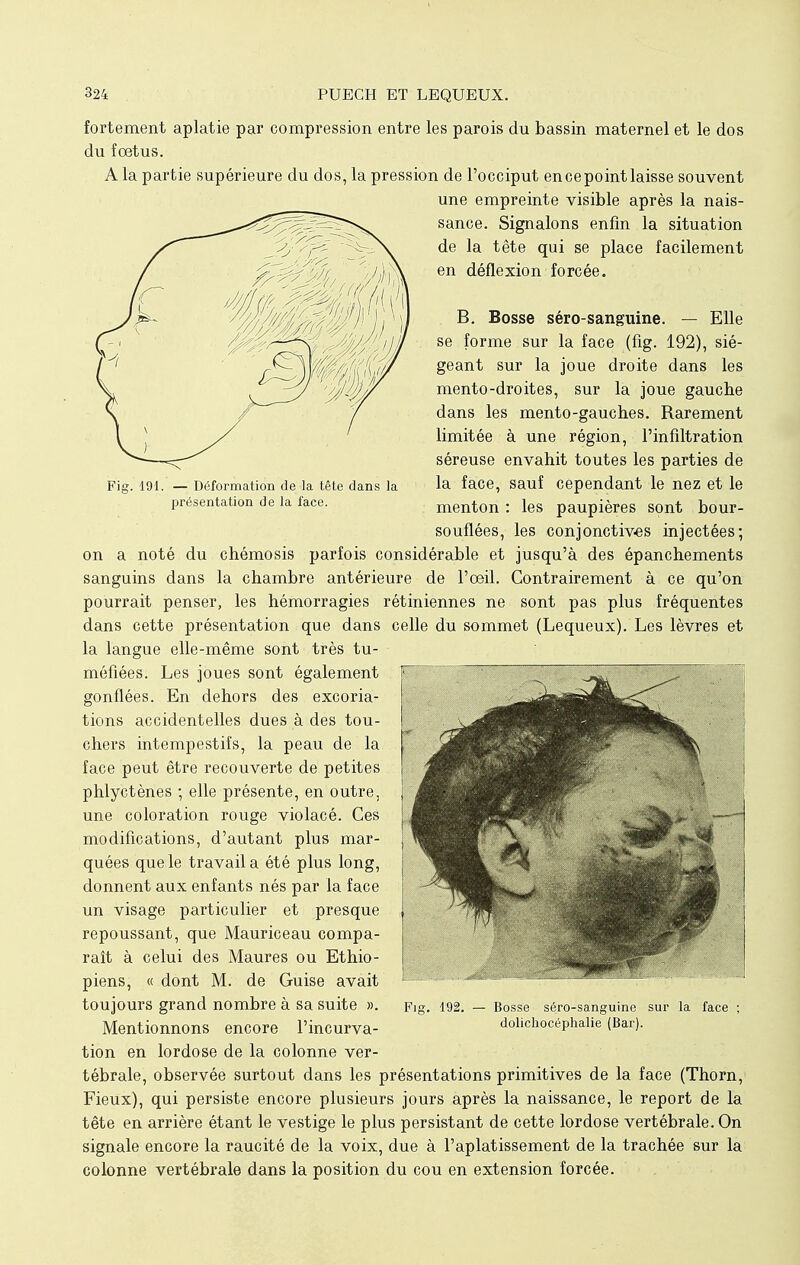 fortement aplatie par compression entre les parois du bassin maternel et le dos du foetus. A la partie supérieure du dos, la pression de l'occiput en ce point laisse souvent une empreinte visible après la nais- sance. Signalons enfin la situation de la tête qui se place facilement en déflexion forcée. B. Bosse séro-sanguine. — Elle se forme sur la face (fig. 192), sié- geant sur la joue droite dans les mento-droites, sur la joue gauche dans les mento-gauches. Rarement limitée à une région, l'infiltration séreuse envahit toutes les parties de la face, sauf cependant le nez et le menton : les paupières sont bour- souflées, les conjonctives injectées; on a noté du chémosis parfois considérable et jusqu'à des épanchements sanguins dans la chambre antérieure de l'oeil. Contrairement à ce qu'on pourrait penser, les hémorragies rétiniennes ne sont pas plus fréquentes dans cette présentation que dans celle du sommet (Lequeux). Les lèvres et la langue elle-même sont très tu- méfiées. Les joues sont également gonflées. En dehors des excoria- tions accidentelles dues à des tou- chers intempestifs, la peau de la face peut être recouverte de petites phlyctènes ; elle présente, en outre, une coloration rouge violacé. Ces modifications, d'autant plus mar- quées que le travail a été plus long, donnent aux enfants nés par la face un visage particulier et presque repoussant, que Mauriceau compa- raît à celui des Maures ou Ethio- piens, « dont M. de Guise avait toujours grand nombre à Sa Suite ». Fig. 192. — Bosse séro-sanguine sur la face ; Mentionnons encore l'incurva- dolichocéphalie (Bar), tion en lordose de la colonne ver- tébrale, observée surtout dans les présentations primitives de la face (Thorn, Fieux), qui persiste encore plusieurs jours après la naissance, le report de la tête en arrière étant le vestige le plus persistant de cette lordose vertébrale. On signale encore la raucité de la voix, due à l'aplatissement de la trachée sur la colonne vertébrale dans la position du cou en extension forcée. Fig. 191. — Déformation de la tête dans la présentation de la face.