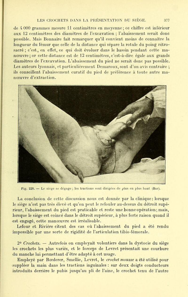 de 4 000 grammes mesure 11 centimètres en moyenne; ce chiffre est inférieur aux 12 centimètres des diamètres de l'excavation ; l'abaissement serait donc possible. Mais Bonnaire fait remarquer qu'il convient moins de connaître la longueur du fémur que celle de la distance qui sépare la rotule du poing rétro- sacré ; c'est, en effet, ce qui doit évoluer dans le bassin pendant cette ma- noeuvre ; or cette distance est de 12 centimètres, c'est-à-dire égale aux grands diamètres de l'excavation. L'abaissement du pied ne serait donc pas possible. Les auteurs lyonnais, et particulièrement Demaroux, sont d'un avis contraire ; ils conseillent l'abaissement curatif du pied de préférence à toute autre ma- noeuvre d'extraction. Fig. 228. — Le siège se dégage ; les tractions sont dirigées de plus en plus haut (Bar). La conclusion de cette discussion nous est donnée par la clinique: lorsque le siège n'est pas très élevé et qu'on peut le refouler au-dessus du détroit supé- rieur, l'abaissement du pied est praticable et reste une bonne opération; mais, lorsque le siège est coincé dans le détroit supérieur, à plus forte raison quand il est engagé, cette manœuvre est irréalisable. Lefour et Rivière citent des cas où l'abaissement du pied a été rendu impossible par une sorte de rigidité de l'articulation tibio-fémorale. 2° Crochets. — Autrefois on employait volontiers dans la dystocie du siège les crochets les plus variés, et le forceps de Levret présentait une courbure du manche lui permettant d'être adapté à cet usage. Employé par Rcederer, Smellie, Levret, le crochet mousse a été utilisé pour suppléer la main dans les tractions inguinales : sur deux doigts conducteurs introduits derrière le pubis jusqu'au pli de l'aine, le crochet tenu de l'autre