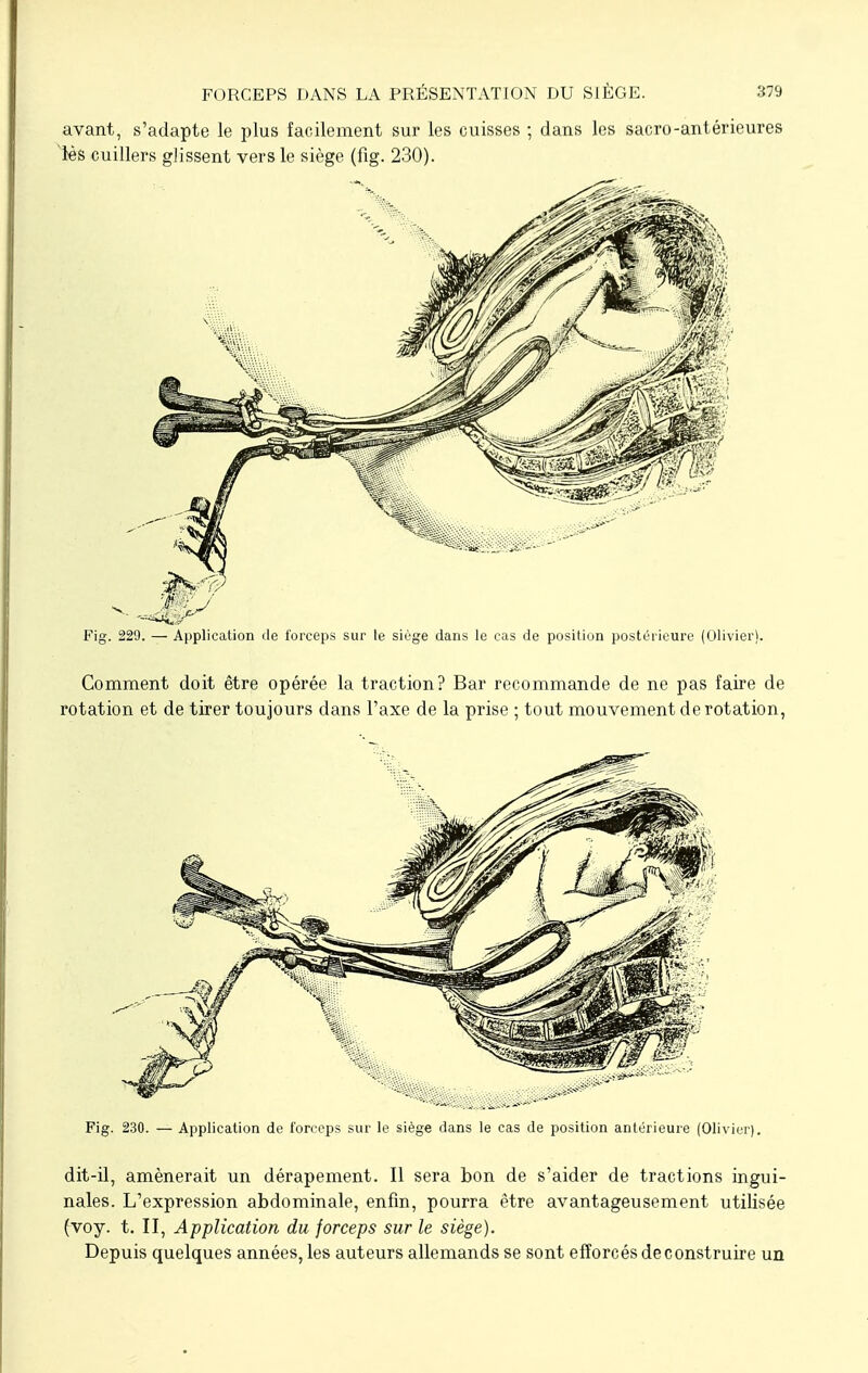 avant, s'adapte le plus facilement sur les cuisses ; dans les sacro-antérieures lés cuillers glissent vers le siège (fig. 230). Fig. 229. — Application de forceps sur le siège dans le cas de position postérieure (Olivier). Comment doit être opérée la traction? Bar recommande de ne pas faire de rotation et de tirer toujours dans l'axe de la prise ; tout mouvement de rotation, Fig. 230. — Application de forceps sur le siège dans le cas de position antérieure (Olivier). dit-il, amènerait un dérapement. Il sera bon de s'aider de tractions ingui- nales. L'expression abdominale, enfin, pourra être avantageusement utilisée (voy. t. II, Application du forceps sur le siège). Depuis quelques années, les auteurs allemands se sont efforcés de construire un