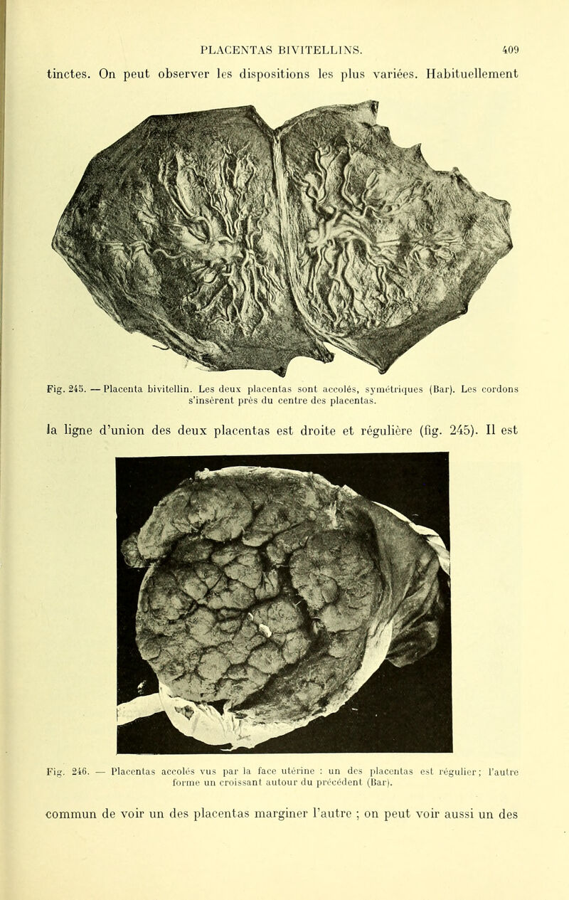 tinctes. On peut observer les dispositions les plus variées. Habituellement Fig. 245. —Placenta bivitellin. Les deux placentas sont accolés, symétriques (Bar). Les cordons s'insèrent près du centre des placentas. la ligne d'union des deux placentas est droite et régulière (fig. 245). Il est Fig. 246. — Placentas accolés vus par la face utérine : un des placentas est régulier; l'autre forme un croissant autour du précédent (Bar). commun de voir un des placentas marginer l'autre ; on peut voir aussi un des