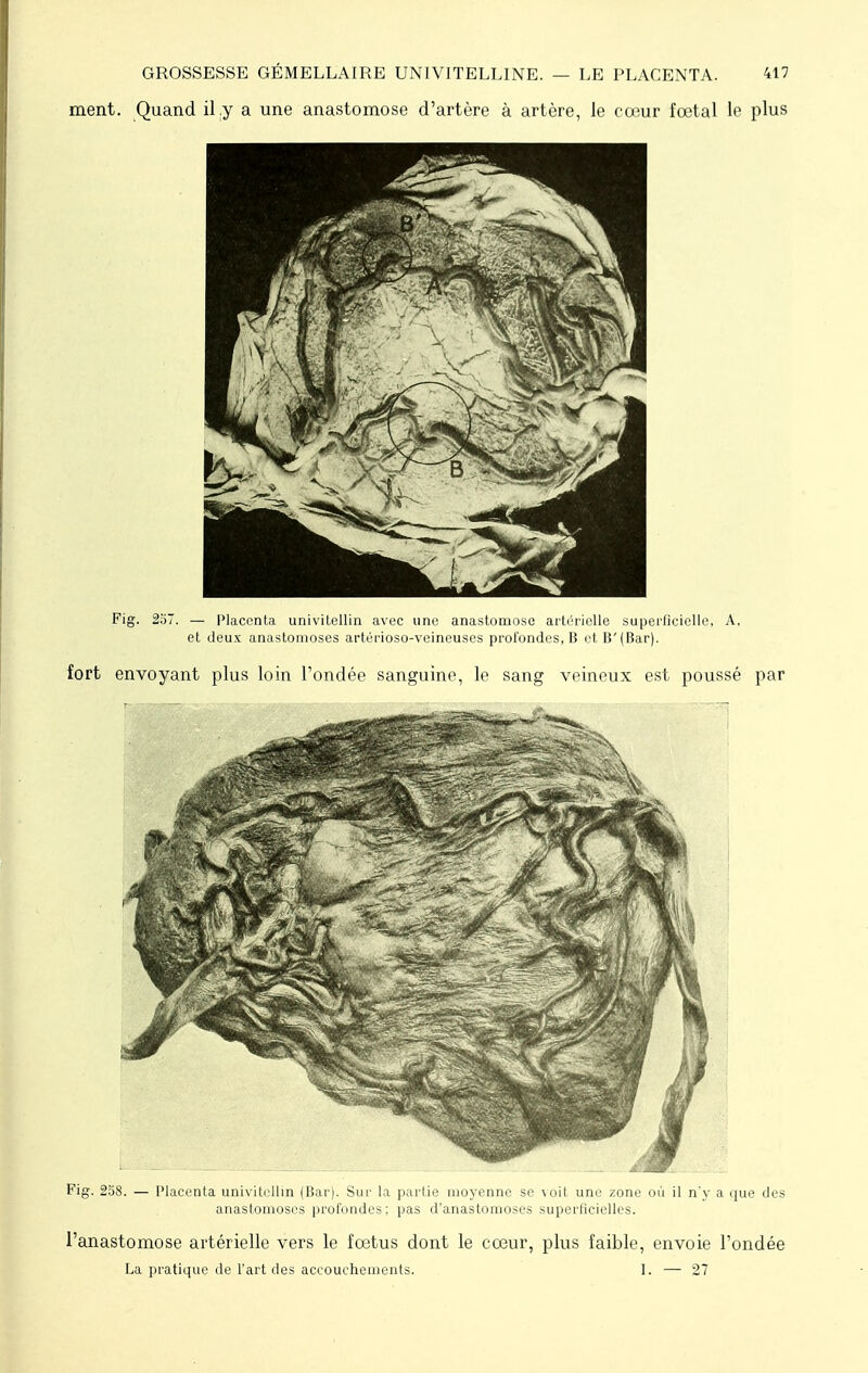 ment. Quand il y a une anastomose d'artère à artère, le cœur fœtal le plus Fig. 2o7. — Placenta univitellin avec une anastomose artérielle superficielle, A, et deux anastomoses artérioso-veineuses profondes, B et B'(Bar). fort envoyant plus loin l'ondée sanguine, le sang veineux est poussé par Fig. 258. — Placenta univitellin (Bar). Sur la partie moyenne se voit une zone où il n'y a que des anastomoses profondes; pas d'anastomoses superficielles. l'anastomose artérielle vers le fœtus dont le cœur, plus faible, envoie l'ondée La pratique de l'art des accouchements. 1. — 27