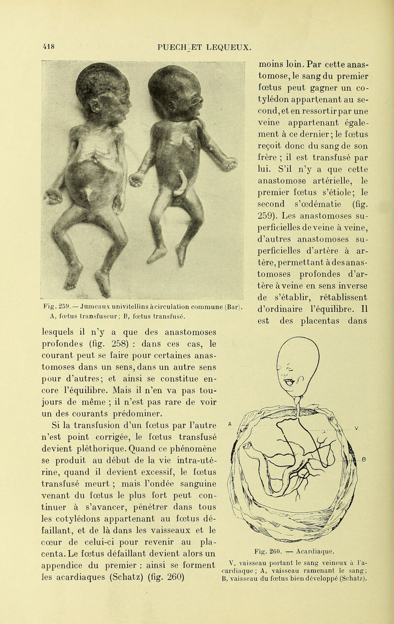 Fig. 259. — Jumeaux univitellins àcirculation commune (Bar). A, fœtus transfuscur; B, fœtus transfusé. lesquels il n'y a que des anastomoses profondes (fig. 258) : dans ces cas, le courant peut se faire pour certaines anas- tomoses dans un sens, dans un autre sens pour d'autres; et ainsi se constitue en- core l'équilibre. Mais il n'en va pas tou- jours de même ; il n'est pas rare de voir un des courants prédominer. Si la transfusion d'un fœtus par l'autre n'est point corrigée, le foetus transfusé devient pléthorique. Quand ce phénomène se produit au début de la vie intra-uté- rine, quand il devient excessif, le fœtus transfusé meurt ; mais l'ondée sanguine venant du fœtus le plus fort peut con- tinuer à s'avancer, pénétrer dans tous les cotylédons appartenant au fœtus dé- faillant, et de là dans les vaisseaux et le cœur de celui-ci pour revenir au pla- centa. Le fœtus défaillant devient alors un appendice du premier : ainsi se forment les acardiaques (Schatz) (fig. 260) moins loin. Par cette anas- tomose, le sang du premier fœtus peut gagner un co- tylédon appartenant au se- condât en ressortir par une veine appartenant égale- ment à ce dernier ; le fœtus reçoit donc du sang de son frère ; il est transfusé par lui. S'il n'y a que cette anastomose artérielle, le premier fœtus s'étiole; le second s'œdématie (fig. 259). Les anastomoses su- perficielles déveine à veine, d'autres anastomoses su- perficielles d'artère à ar- tère, permettant à des anas- tomoses profondes d'ar- tère à veine en sens inverse de s'établir, rétablissent d'ordinaire l'équilibre. Il est des placentas dans Fig. 260. — Acardiaque. V, vaisseau portant le sang veineux à l'a- cardiaque ; A, vaisseau ramenant le sang; B, vaisseau du fœtus bien développé (Schatz).