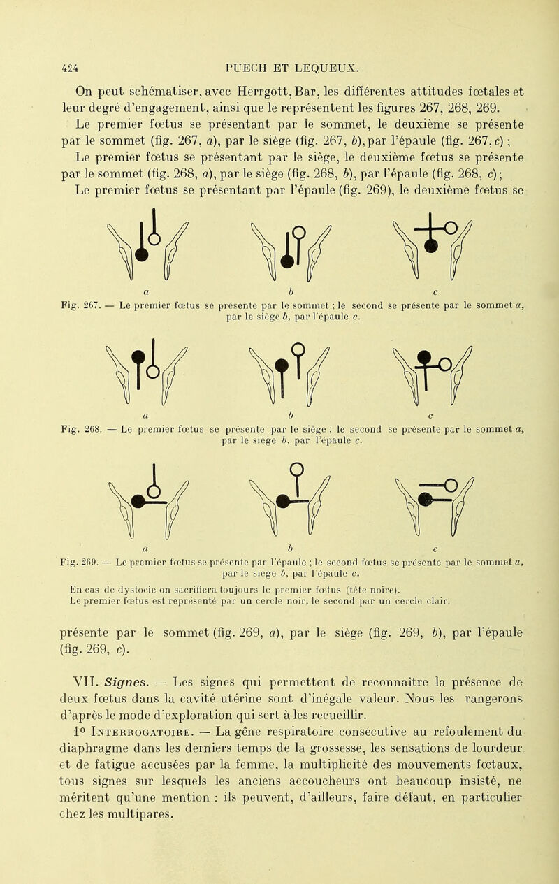 On peut schématiser, avec Herrgott, Bar, les différentes attitudes foetales et leur degré d'engagement, ainsi que le représentent les figures 267, 268, 269. Le premier fœtus se présentant par le sommet, le deuxième se présente par le sommet (fig. 267, a), par le siège (fig. 267, è),par l'épaule (fig. 267, c) ; Le premier fœtus se présentant par le siège, le deuxième fœtus se présente par le sommet (fig. 268, a), par le siège (fig. 268, ô), par l'épaule (fig. 268, c) ; Le premier fœtus se présentant par l'épaule (fig. 269), le deuxième fœtus se abc Fig. 267. — Le premier fœtus se présente par le sommet ; le second se présente par le sommet a, par le siège b, par l'épaule c. a b c Fig. 268. — Le premier fœtus se présente par le siège ; le second se présente par le sommet a, par le siège b, par l'épaule c. abc Fig. 269. — Le premier fœtus se présente par l'épaule ; le second fœtus se présente par le sommet a, par le siège b, par l'épaule c. En cas de dystocie on sacrifiera toujours le premier fœtus (tête noire). Le premier fœtus est représenté par un cercle noir, le second par un cercle clair. présente par le sommet (fig. 269, a), par le siège (fig. 269, b), par l'épaule (fig. 269, c). VII. Signes. — Les signes qui permettent de reconnaître la présence de deux fœtus dans la cavité utérine sont d'inégale valeur. Nous les rangerons d'après le mode d'exploration qui sert à les recueillir. 1° Interrogatoire. — La gêne respiratoire consécutive au refoulement du diaphragme dans les derniers temps de la grossesse, les sensations de lourdeur et de fatigue accusées par la femme, la multiplicité des mouvements fœtaux, tous signes sur lesquels les anciens accoucheurs ont beaucoup insisté, ne méritent qu'une mention : ils peuvent, d'ailleurs, faire défaut, en particulier chez les multipares.