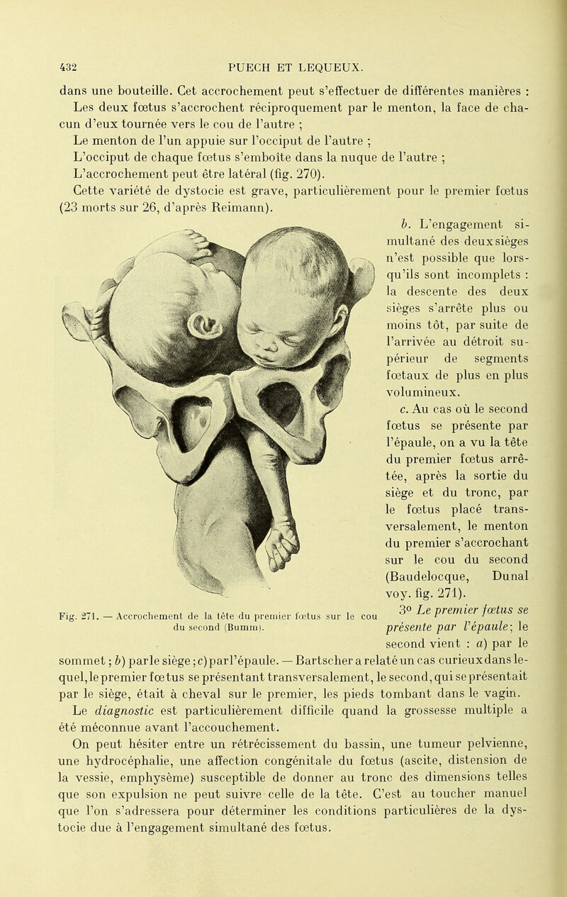 dans une bouteille. Cet accrochement peut s'effectuer de différentes manières : Les deux fœtus s'accrochent réciproquement par le menton, la face de cha- cun d'eux tournée vers le cou de l'autre ; Le menton de l'un appuie sur l'occiput de l'autre ; L'occiput de chaque foetus s'emboîte dans la nuque de l'autre ; L'accrochement peut être latéral (fig. 270). Cette variété de dystocie est grave, particulièrement pour le premier fœtus (23 morts sur 26, d'après Reimann). b. L'engagement si- multané des deux sièges n'est possible que lors- qu'ils sont incomplets : la descente des deux sièges s'arrête plus ou moins tôt, par suite de l'arrivée au détroit su- périeur de segments fœtaux de plus en plus volumineux. c. Au cas où le second fœtus se présente par l'épaule, on a vu la tête du premier fœtus arrê- tée, après la sortie du siège et du tronc, par le fœtus placé trans- versalement, le menton du premier s'accrochant sur le cou du second (Baudelocque, Dunal voy. fig. 271). Fig. 271. — Accrochement de la tète du premier fœtus sur le cou ^ premier joztUS Se du second (Bumm). présente par Vépaule; le second vient : à) par le sommet ; b) parle siège ; c) parl'épaule. — Bartscher a relaté un cas curieux dans le- quel,le premier fœtus se présentant transversalement, le second, qui se présentait par le siège, était à cheval sur le premier, les pieds tombant dans le vagin. Le diagnostic est particulièrement difficile quand la grossesse multiple a été méconnue avant l'accouchement. On peut hésiter entre un rétrécissement du bassin, une tumeur pelvienne, une hydrocéphalie, une affection congénitale du fœtus (ascite, distension de la vessie, emphysème) susceptible de donner au tronc des dimensions telles que son expulsion ne peut suivre celle de la tête. C'est au toucher manuel que l'on s'adressera pour déterminer les conditions particulières de la dys- tocie due à l'engagement simultané des fœtus.