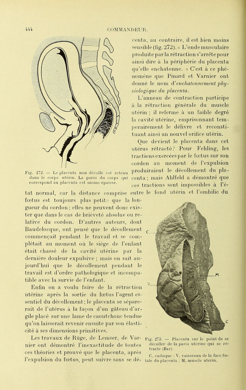 Fig. 272. — Le placenta non décollé est retenu dans le corps utérin. La paroi du corps qui correspond au placenta est moins épaisse. tat normal, car la distance comprise fœtus est toujours plus petite que la lon- gueur du cordon; elles ne peuvent donc exis- ter que dans le cas de brièveté absolue ou re- lative du cordon. D'autres auteurs, dont Baudelocque, ont pensé que le décollement commençait pendant le travail et se com- plétait au moment où le siège de l'enfant était chassé de la cavité utérine par la dernière douleur expulsive ; mais on sait au- jourd'hui que le décollement pendant le travail est d'ordre pathologique et incompa- tible avec la survie de l'enfant. Enfin on a voulu faire de la rétraction utérine après la sortie du foetus l'agent es- sentiel du décollement; le placenta se sépare- rait de l'utérus à la façon d'un gâteau d'ar- gile placé sur une lame de caoutchouc tendue qu'on laisserait revenir ensuite par son élasti- cité à ses dimensions primitives. Les travaux de Riige, de Lemser, de Var- nier ont démontré l'inexactitude de toutes ces théories et prouvé que le placenta, après l'expulsion du fœtus, peut suivre sans se dé- centa, au contraire, il est bien moins sensible (fig. 272). « L'onde musculaire produite par la rétraction s'arrête pour ainsi dire à la périphérie du placenta qu'elle enchatonne. » C'est à ce phé- nomène que Pinard et Varnier ont donné le nom d'enchatonnement phy- siologique du placenta. L'anneau de contraction participe à la rétraction générale du muscle utérin ; il referme à un faible degré la cavité utérine, emprisonnant tem- porairement le délivre et reconsti- tuant ainsi un nouvel orifice utérin. Que devient le placenta dans cet utérus rétracté? Pour Fehling, les tractions exercées par le fœtus sur son cordon au moment de l'expulsion produiraient le décollement du pla- centa ; mais Ahlfeld a démontré que ces tractions sont impossibles à l'é- entre le fond utérin et l'ombilic du Fig. 273. — Placenta sur le point de se décoller de la paroi utérine qui se ré- tracle (Bar). C, caduque ; V, vaisseaux de la face fœ- tale du placenta ; M, muscle utérin.