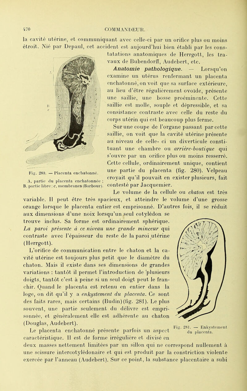 Fig. 280. — Placenta enchatonné. A, partie du placenta enchatonnée B, partie libre : c, membranes (Barbour) la cavité utérine, et communiquant avec celle-ci par un orifice plus ou moins étroit. Nié par Depaul, cet accident est aujourd'hui bien établi par les cons- tatations anatomiques de Herrgott, les tra- vaux de Bubendorff, Audebert, etc. Anatomie pathologique. — Lorsqu'on examine un utérus renfermant un placenta enchatonné, on voit que sa surface extérieure, au lieu d'être régulièrement ovoïde, présente une saillie, une bosse proéminente. Cette saillie est molle, souple et dépressible, et sa consistance contraste avec celle du reste du corps utérin qui est beaucoup plus ferme. Sur une coupe de l'organe passant par cette saillie, on voit que la cavité utérine présente au niveau de celle- ci un diverticule consti- tuant une chambre ou arrière-boutique qui s'ouvre par un orifice plus ou moins resserré. Cette cellule, ordinairement unique, contient une partie du placenta (fig. 280). Velpeau croyait qu'il pouvait en exister plusieurs, fait contesté par Jacquemier. Le volume de la cellule ou chaton est très variable. Il peut être très spacieux, et atteindre le volume d'une grosse orange lorsque le placenta entier est emprisonné. D'autres fois, il se réduit aux dimensions d'une noix lorsqu'un seul cotylédon se trouve inclus. Sa forme est ordinairement sphérique. La paroi présente à ce niveau une grande minceur qui contraste avec l'épaisseur du reste de la paroi ^térine (Herrgott). L'orifice de communication entre le chaton et la ca- vité utérine est toujours plus petit que le diamètre du chaton. Mais il existe dans ses dimensions de grandes variations : tantôt il permet l'introduction de 'plusieurs doigts, tantôt c'est à peine si un seul doigt peut le fran- chir. Quand le placenta est retenu en entier dans la loge, on dit qu'il y a enkystement du placenta. Ce sont des faits rares, mais certains (Budin)(fig. 281). Le plus souvent, une partie seulement du délivre est empri- sonnée, et généralement elle est adhérente au chaton (Douglas, Audebert). Le placenta enchatonné présente parfois un aspect caractéristique. Il est de forme irrégulière et divisé en deux masses nettement limitées par un sillon qui ne correspond nullement à une scissure intercotylédonaire et qui est produit par la constriction violente exercée par l'anneau (Audebert). Sur ce point, la substance placentaire a subi Fig. 281. — Enkystement du placenta.