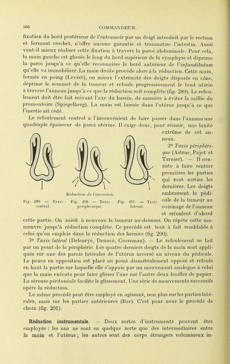 fixation du bord postérieur de l'entonnoir par un doigt introduit par le rectum et formant crochet, n'offre aucune garantie et traumatise l'intestin. Aussi vaut-il mieux réaliser cette fixation à travers la paroi abdominale. Pour cela, la main gauche est glissée le long du bord supérieur de la symphyse et déprime la paroi jusqu'à ce qu'elle reconnaisse le bord antérieur de Vinfundibulum qu'elle va immobiliser. La main droite procède alors à la réduction. Cette main, fermée en poing (Levret), ou mieux l'extrémité des doigts disposés en cône, déprime le sommet de la tumeur et refoule progressivement le fond utérin à travers l'anneau jusqu'à ce que la réduction soit complète (fig. 289). Le refou- lement doit être fait suivant l'axe du bassin, de manière à éviter la saillie du promontoire (Spiegelberg). La main est laissée dans l'utérus jusqu'à ce que l'inertie ait cédé. Le refoulement central a l'inconvénient de faire passer dans l'anneau une quadruple épaisseur de paroi utérine. Il exige donc, pour réussir, une laxité extrême de cet an- neau. 2° Taxis périphéri- que (Astruc, Pajot et Tarnier). — Il con- siste à faire rentrer premières les parties qui sont sorties les dernières. Les doigts embrassent le pédi- Fig. 289. — Taxis Fig. 290. — Taxis Fig. 291. — Taxis Cu^e ^e ^a tumeur au central. périphérique. latéral. voisinage de l'anneau et refoulent d'abord cette partie. On saisit à nouveau la tumeur au-dessous. On répète cette ma- nœuvre jusqu'à réduction complète. Ce procédé est tout à fait semblable à celui qu'on emploie dans la réduction des hernies (fig. 290). 3° Taxis latéral (Deleurye, Denucé, Cooseman). — Le refoulement se fait par un point de la périphérie. Les quatre derniers doigts de la main sont appli- qués sur une des parois latérales de l'utérus inversé au niveau du pédicule. Le pouce en opposition est placé au point diamétralement opposé et refoule en haut la partie sur laquelle elle s'appuie par un mouvement analogue à celui . que la main exécute pour faire glisser l'une sur l'autre deux feuilles de papier. La séreuse péritonéale facilite le glissement. Une série de mouvements successifs opère la réduction. Le même procédé peut être employé en agissant, non plus sur les parties laté- rales, mais sur les parties antérieures (Bar). C'est pour nous le procédé de choix (fig. 291). Réduction instrumentale. — Deux sortes d'instruments peuvent être employés : les uns ne sont en quelque sorte que des intermédiaires entre la main et l'utérus ; les autres sont des corps étrangers volumineux in- Réduction de l'inversion.