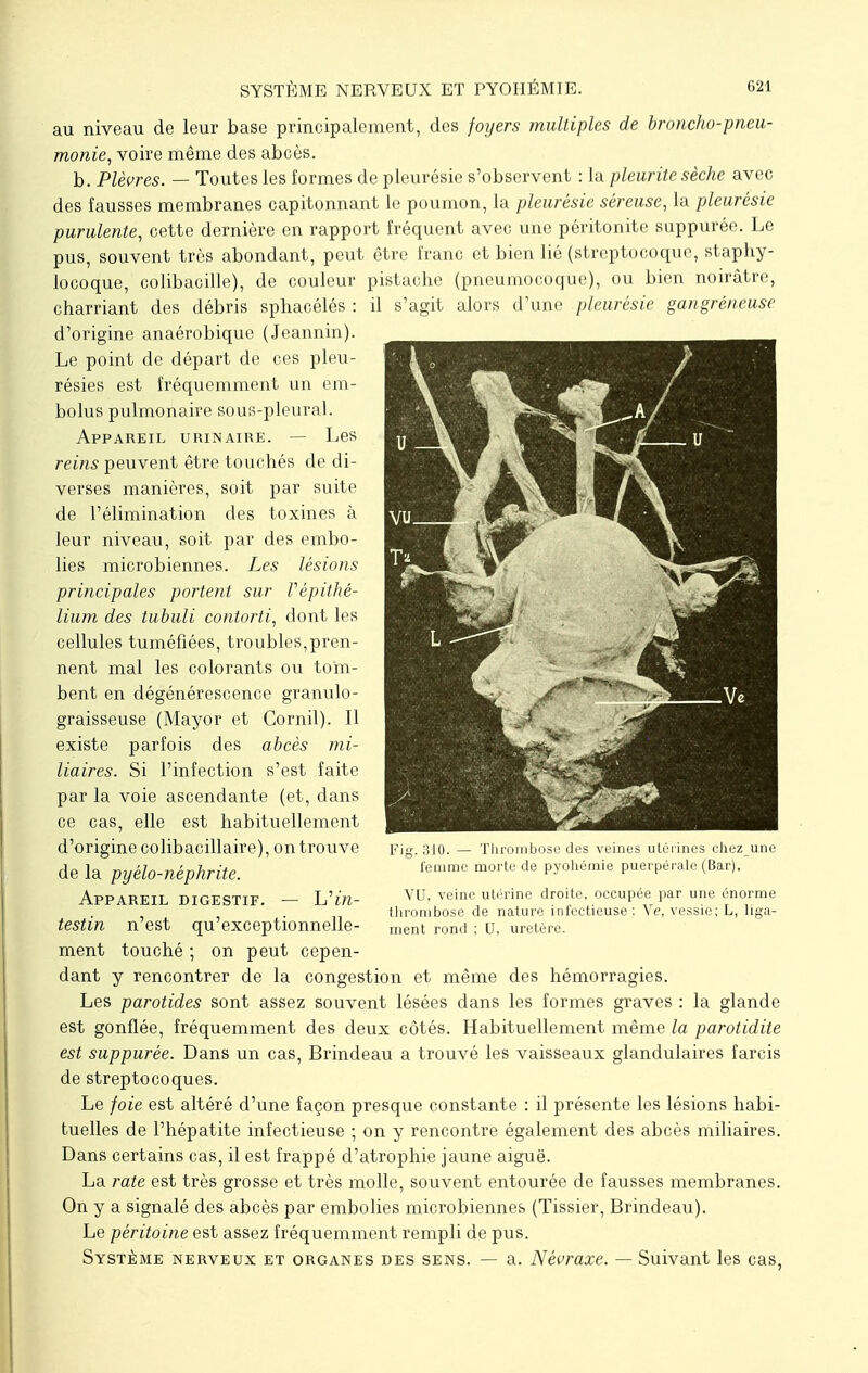 SYSTÈME NERVEUX ET PYOIIÉMIE. G21 au niveau de leur base principalement, des foyers multiples de broncho-pneu- monie, voire même des abcès. b. Plèvres. — Toutes les formes de pleurésie s'observent : la pleurite sèche avec des fausses membranes capitonnant le poumon, la pleurésie séreuse, la pleurésie purulente, cette dernière en rapport fréquent avec une péritonite suppurée. Le pus, souvent très abondant, peut être franc et bien lié (streptocoque, staphy- locoque, colibacille), de couleur pistache (pneumocoque), ou bien noirâtre, charriant des débris sphacélés : il s'agit alors d'une pleurésie gangreneuse d'origine anaérobique (Jeannin). Le point de départ de ces pleu- résies est fréquemment un em- bolus pulmonaire sous-pleural. Appareil urinaire. — Les reins peuvent être touchés de di- verses manières, soit par suite de l'élimination des toxines à leur niveau, soit par des embo- lies microbiennes. Les lésions principales portent sur Vèpithé- lium des tubuli contorti, dont les cellules tuméfiées, troubles,pren- nent mal les colorants ou tom- bent en dégénérescence granulo- graisseuse (Mayor et Cornil). 11 existe parfois des abcès mi- liaires. Si l'infection s'est faite par la voie ascendante (et, dans ce cas, elle est habituellement d'origine colibacillaire), on trouve de la pyélo-nèphrite. Appareil digestif. — ^in- testin n'est qu'exceptionnelle- ment touché ; on peut cepen- dant y rencontrer de la congestion et même des hémorragies. Les parotides sont assez souvent lésées dans les formes graves : la glande est gonflée, fréquemment des deux côtés. Habituellement même la parotidite est suppurée. Dans un cas, Brindeau a trouvé les vaisseaux glandulaires farcis de streptocoques. Le foie est altéré d'une façon presque constante : il présente les lésions habi- tuelles de l'hépatite infectieuse ; on y rencontre également des abcès miliaires. Dans certains cas, il est frappé d'atrophie jaune aiguë. La rate est très grosse et très molle, souvent entourée de fausses membranes. On y a signalé des abcès par embolies microbiennes (Tissier, Brindeau). Le péritoine est assez fréquemment rempli de pus. Système nerveux et organes des sens. — a. Névraxe. — Suivant les cas, Fig. 310. — Thrombose des veines utérines chez une femme morte de pyohémie puerpérale (Bar), VU, veine utérine droite, occupée par une énorme thrombose de nature infectieuse ; Ne, vessie; L, liga- ment rond ; U, uretère.