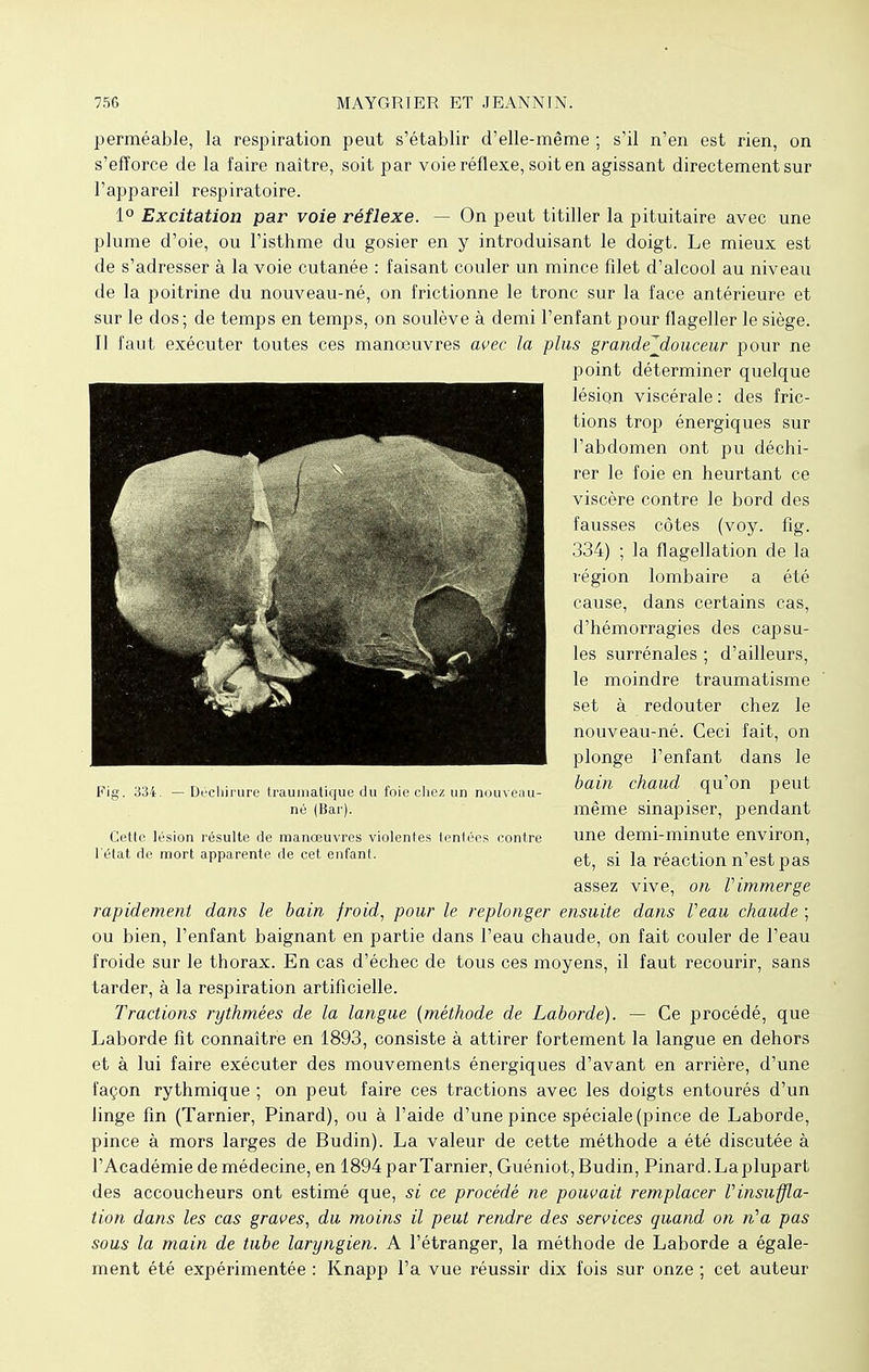 perméable, la respiration peut s'établir d'elle-même ; s'il n'en est rien, on s'efforce de la faire naître, soit par voie réflexe, soit en agissant directement sur l'appareil respiratoire. 1° Excitation par voie réflexe. — On peut titiller la pituitaire avec une plume d'oie, ou l'isthme du gosier en y introduisant le doigt. Le mieux est de s'adresser à la voie cutanée : faisant couler un mince filet d'alcool au niveau de la poitrine du nouveau-né, on frictionne le tronc sur la face antérieure et sur le dos; de temps en temps, on soulève à demi l'enfant pour flageller le siège. Il faut exécuter toutes ces manœuvres avec la plus grandejiouceur pour ne point déterminer quelque lésion viscérale : des fric- tions trop énergiques sur l'abdomen ont pu déchi- rer le foie en heurtant ce viscère contre le bord des fausses côtes (voy. fig. 334) ; la flagellation de la région lombaire a été cause, dans certains cas, d'hémorragies des capsu- les surrénales ; d'ailleurs, le moindre traumatisme set à redouter chez le nouveau-né. Ceci fait, on plonge l'enfant dans le bain chaud qu'on peut né (Bar). même sinapiser, pendant Cette lésion résulte de manœuvres violentes tentées contre une demi-minute environ, l'état de mort apparente de cet enfant. et? gi ja faction n'est pas assez vive, on l'immerge rapidement dans le bain froid, pour le replonger ensuite dans Veau chaude ; ou bien, l'enfant baignant en partie dans l'eau chaude, on fait couler de l'eau froide sur le thorax. En cas d'échec de tous ces moyens, il faut recourir, sans tarder, à la respiration artificielle. Tractions rythmées de la langue (méthode de Labordé). — Ce procédé, que Laborde fît connaître en 1893, consiste à attirer fortement la langue en dehors et à lui faire exécuter des mouvements énergiques d'avant en arrière, d'une façon rythmique ; on peut faire ces tractions avec les doigts entourés d'un linge fin (Tarnier, Pinard), ou à l'aide d'une pince spéciale (pince de Laborde, pince à mors larges de Budin). La valeur de cette méthode a été discutée à l'Académie de médecine, en 1894 par Tarnier, Guéniot, Budin, Pinard. La plupart des accoucheurs ont estimé que, si ce procédé ne pouvait remplacer l'insuffla- tion dans les cas graves, du moins il peut rendre des services quand on n'a pas sous la main de tube laryngien. A l'étranger, la méthode de Laborde a égale- ment été expérimentée : Knapp l'a vue réussir dix fois sur onze ; cet auteur