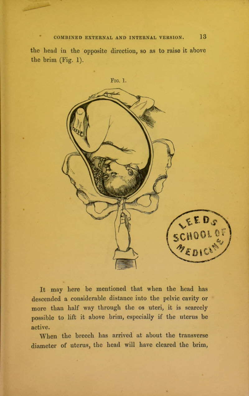 the head in the opposite direction, so as to raise it above the brim (Fig. 1). Fig. 1. It may here be mentioned that when the head has descended a considerable distance into the pelvic cavity or more than half way through the os uteri, it is scarcely possible to lift it above brim, especially if the uterus be active. When the breech has arrived at about the transverse diameter of uterus, the head will have cleared the brim,