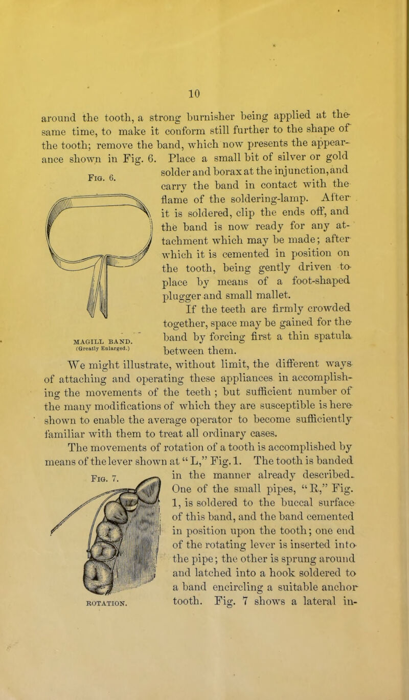 around the tooth, a strong burnisher being applied at the- same time, to make it conform still further to the shape of the tooth; remove the band, which now presents the appear- ance shown in Fig. 6. Place a small hit of silver or gold solder and borax at the injunction, and carry the band in contact with the flame of the soldering-lamp. Alter it is soldered, clip the ends off, and the band is now ready for any at- tachment which may be made; after which it is cemented in position on the tooth, being gently driven to- pi ace by means of a foot-shaped plugger and small mallet. If the teeth are firmly crowded together, space may he gained for the band by forcing first a thin spatula between them. We might illustrate, without limit, the different ways of attaching and operating these appliances in accomplish- ing the movements of the teeth ; but sufficient number of the many modifications of which they are susceptible is here- shown to enable the average operator to become sufficiently familiar with them to treat all ordinary cases. The movements of rotation of a tooth is accomplished by means of the lever shown at “ L,” Fig. 1. The tooth is banded in the manner already described. One of the small pipes, “R,” Fig. 1, is soldered to the buccal surface of this band, and the band cemented in position upon the tooth; one end of the rotating lever is inserted into the pipe; the other is sprung around and latched into a hook soldered to a band encircling a suitable anchor tooth. Fig. 7 shows a lateral in-
