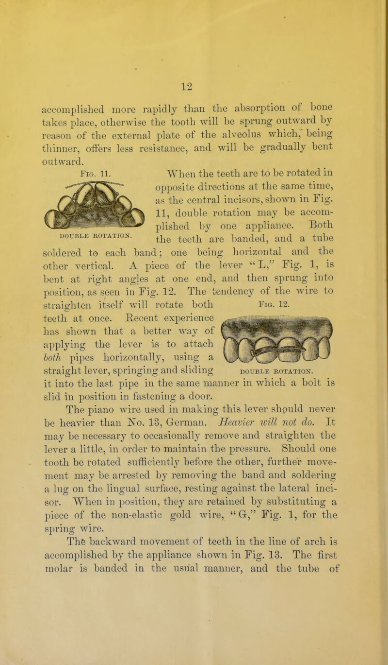 accomplished more rapidly than the absorption oi bone takes place, otherwise the tooth will be sprung outward by reason of the external plate of the alveolus which, being thinner, otters less resistance, and will be gradually bent outward. Fig. 11. When the teeth are to be rotated in opposite directions at the same time, as the central incisors, shown in Fig. 11, double rotation may be accom- plished by one appliance. Both the teeth are banded, and a tube soldered to each band; one being horizontal and the other vertical. A piece of the lever “ L,” Fig. 1, is beut at right angles at one end, and then sprung into position, as seen in Fig. 12. The tendency of the wire to straighten itself will rotate both Fig. 12. teeth at once. Recent experience has shown that a better way of applying the lever is to attach both pipes horizontally, using a straight lever, springing and sliding double rotation. it into the last pipe in the same manner in which a bolt is slid in position in fastening a door. The piano wire used in making this lever should never be heavier than FTo. 13, German. Heavier will not do. It may be necessary to occasionally remove and straighten the lever a little, in order to maintain the pressure. Should one tooth be rotated sufficiently before the other, further move- ment may be arrested by removing the band and soldering a lug on the lingual surface, resting against the lateral inci- sor. When in position, they are retained by substituting a piece of the non-elastic gold wire, “ G,” Fig. 1, for the spring wire. The backward movement of teeth in the line of arch is accomplished by the appliance shown in Fig. 13. The first molar is banded in the usual manner, and the tube of