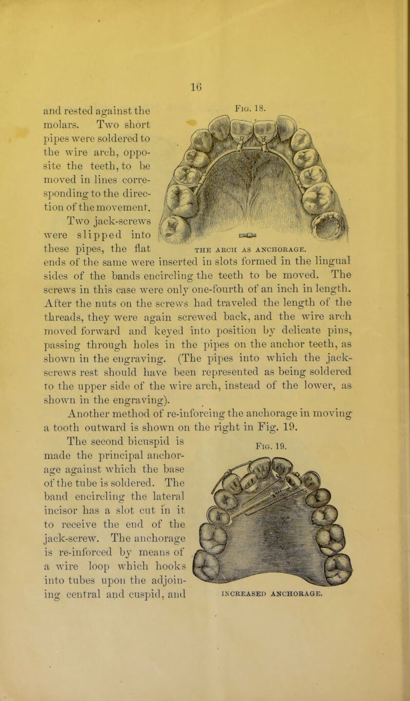 and rested against the Fig- 18- molars. Two short pipes were soldered to the wire arch, oppo- site the teeth, to he moved in lines corre- sponding to the direc- tion of the movement. Two jack-screws were slipped into these pipes, the flat the arch as anchorage. ends of the same were inserted in slots formed in the lingual sides of the bands encircling the teeth to be moved. The screws in this case were only one-fourth of an inch in length. After the nuts on the screws had traveled the length of the threads, they were again screwed back, and the wire arch moved forward and keyed into position by delicate pins, passing through holes in the pipes on the anchor teeth, as shown in the engraving. (The pipes into which the jack- screws rest should have been represented as being soldered to the upper side of the wire arch, instead of the lower, as shown in the engraving). Another method of re-inforcing the anchorage in moving a tooth outward is shown on the right in Fig. 19. The second bicuspid is made the principal anchor- age against which the base of the tube is soldered. The band encircling the lateral incisor has a slot cut in it to receive the end of the jack-screw. The anchorage is re-inforeed by means of a wire loop which hooks into tubes upon the adjoin- ing central and cuspid, and Fig. 19. increased anchorage.