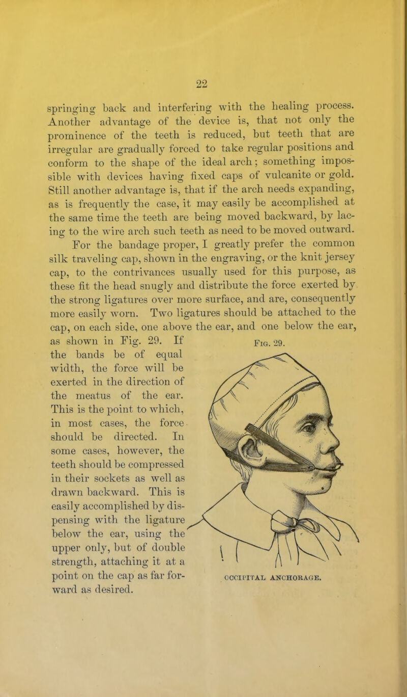 92 springing back and interfering with the healing process. Another advantage of the device is, that not only the prominence of the teeth is reduced, but teeth that are irregular are gradually forced to take regular positions and conform to the shape of the ideal arch; something impos- sible with devices having fixed caps of vulcanite or gold. Still another advantage is, that if the arch needs expanding, as is frequently the case, it may easily be accomplished at the same time the teeth are being moved backward, by lac- ing to the wire arch such teeth as need to be moved outward. For the bandage proper, I greatly prefer the common silk traveling cap, shown in the engraving, or the knit jersey cap, to the contrivances usually used for this purpose, as these fit the head snugly and distribute the force exerted by the strong ligatures over more surface, and are, consequently more easily worn. Two ligatures should be attached to the cap, on each side, one above the ear, and one below the ear, as shown in Fig. 29. If fig. 29. the bands be of equal width, the force will be exerted in the direction of the meatus of the ear. This is the point to which, in most cases, the force should be directed. In some cases, however, the teeth should be compressed in their sockets as well as drawn backward. This is easily accomplished by dis- pensing with the ligature below the ear, using the upper only, but of double strength, attaching it at a point on the cap as far for- occiriTAL anchorage. ward as desired.