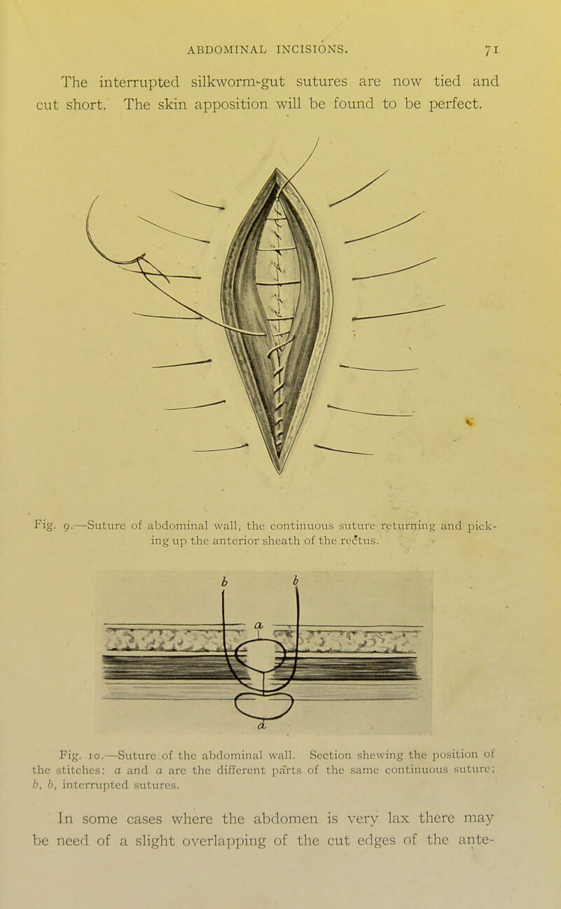 The interrupted silkworm-gut sutures are now tied and cut short. The skin apposition will be found to be perfect. V Fig. 9.—Suture of abdominal wall, the continuous sutm^e returning and pick- ing up the anterior sheath of the rectus. Fig. 10.—Suture of the abdominal wall. Section shewing the position of the stitches: a and a are the different parts of the same continuous suture; b, b, interrupted sutures. In some cases where the abdomen is very lax there may be need of a slight overlapping of the cut edges of the ante-