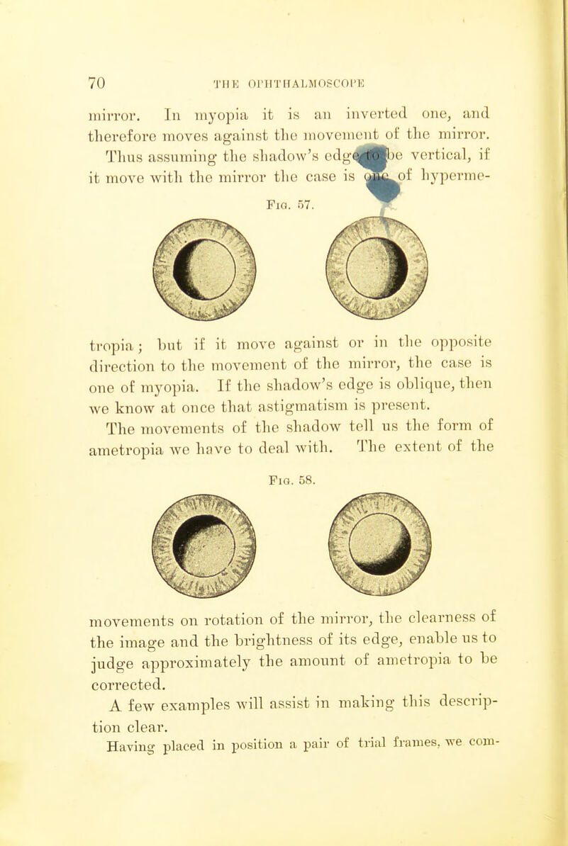 mirror. In myopia it is an inverted one, and therefore moves against the movement of the mirror. Thus assuming the shadow's odg^fce vertical, if it move with the mirror the case is ^^^of hyperme- FiG. 57. tropia; but if it move against or in the opposite direction to the movement of the mirror, the case is one of myopia. If the shadow's edge is oblique, then we know at once that astigmatism is present. The movements of the shadow tell us the form of ametropia Ave have to deal with. The extent of the Fig. 58. movements on rotation of the mirror, the clearness of the image and the brightness of its edge, enable us to judge approximately the amount of ametropia to be corrected. A few examples will assist in making this descrip- tion clear. Having placed in iwsition a jDair of trial frames, we com-