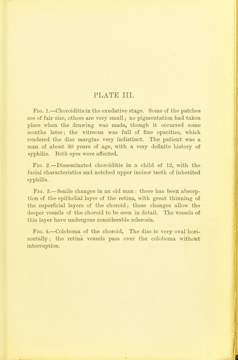 PLATE III. Fig. 1.—Choroiditis in the exiidative stage. Some of the patches are of fair size, others are very small; no pigmentation had taken place when the drawing was made, though it occiu-red some months later; the vitreous was full of fine opacities, which rendered the disc margins very indistinct. The patient was a man of about 30 years of age, with a very definite history of syphilis. Both eyes were affected. Pig. 2.—Disseminated choroiditis in a child of 12, with the facial characteristics and notched upper incisor teeth of inherited syphilis. Fig. 3.—Senile changes in an old man : there has been absoi-p- tion of the epithelial layer of the retina, with great thinning of the superficial layers of the choroid; these changes allow the deeper vessels of the choroid to be seen in detail. The vessels of this layer have undergone considerable sclerosis. Fig. 4.—Coloboma of the choroid. The disc is very oval hori- zontally ; the retina vessels pass over the coloboma without interruption.