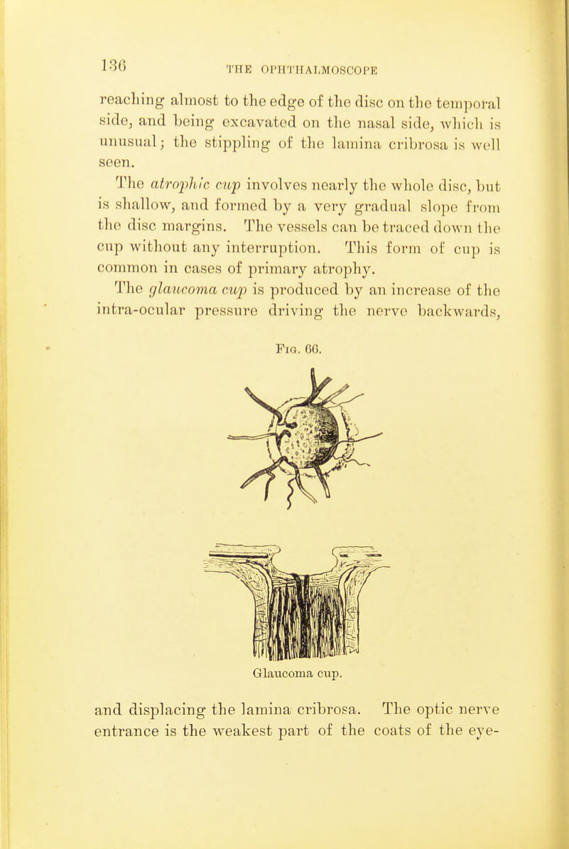THE OPH'1'IIALMOSCOl'E reaching almost to the edge of the disc on the temporal side, and being excavated on the nasal side, which is unusual; the stippling of the lamina cribrosa is well seen. The atrophic cup involves nearly the whole disc, but is shallow, and formed by a very gradual slope from the disc margins. The vessels can be traced down the cup without any interruption. This form of cup is common in cases of primary atrophy. The glaucoma cup is produced by an increase of the intra-ocular pressure driving the nerve backwards. Fia. 60. Glaucoma cup. and displacing the lamina cribrosa. The optic nerve entrance is the weakest part of the coats of the eye-