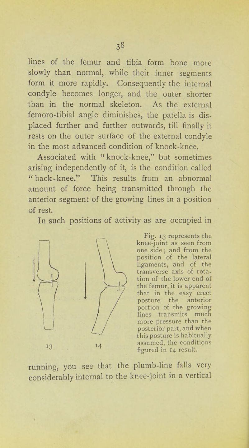 lines of the femur and tibia form bone more slowly than normal, while their inner segments form it more rapidly. Consequently the internal condyle becomes longer, and the outer shorter than in the normal skeleton. As the external femoro-tibial angle diminishes, the patella is dis- placed further and further outwards, till finally it rests on the outer surface of the external condyle in the most advanced condition of knock-knee. Associated with knock-knee, but sometimes arising independently of it, is the condition called back-knee. This results from an abnormal amount of force being transmitted through the anterior segment of the growing lines in a position of rest. In such positions of activity as are occupied in Fig. 13 represents the knee-joint as seen from one side; and from the position of the lateral ligaments, and of the transverse axis of rota- tion of the lower end of the femur, it is apparent that in the easy erect posture the anterior portion of the growing lines transmits much more pressure than the posterior part, and when this posture is habitually assumed, the conditions figured in 14 result. running, you see that the plumb-line falls very considerably internal to the knee-joint in a vertical