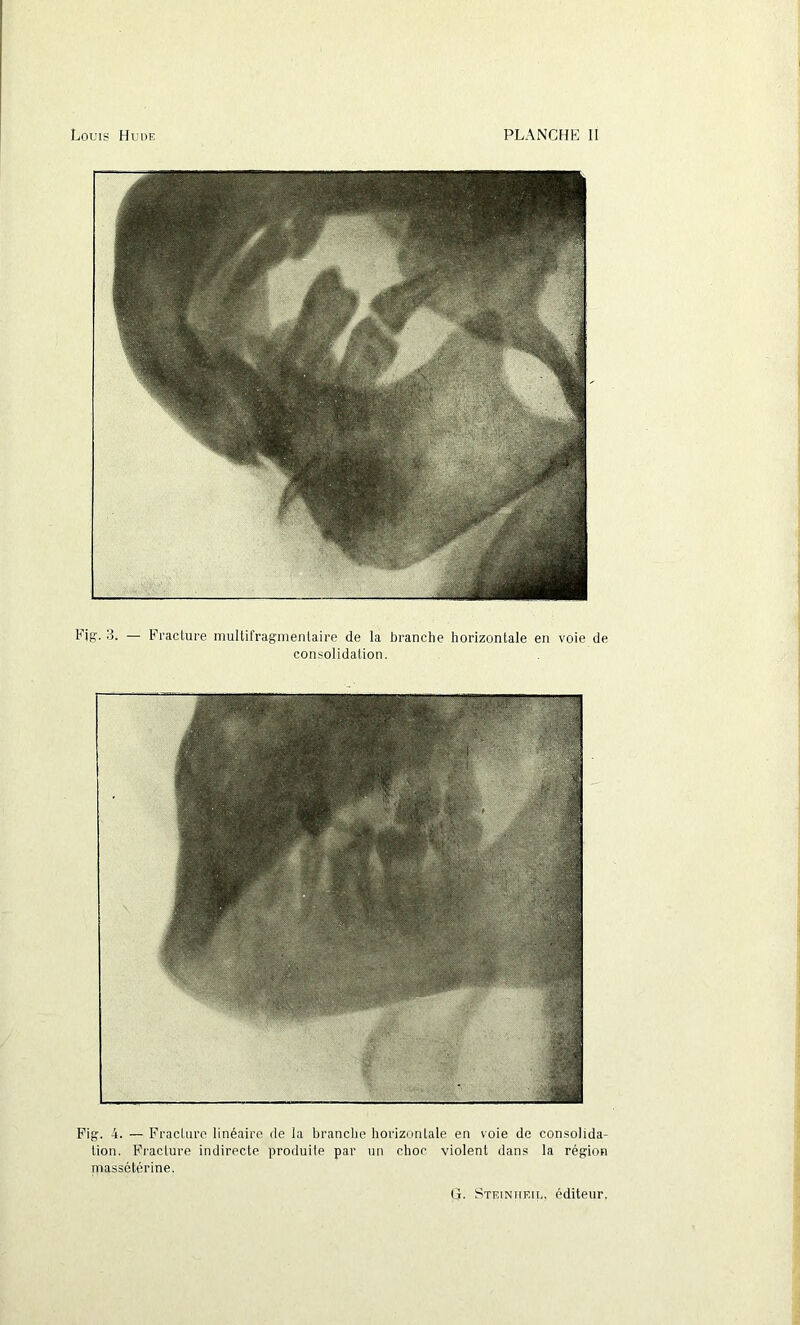 Fig. 3. — Fracture multifragmentaire de la branche horizontale en voie de consolidation. Fig. 4. — Fracture linéaire de la branche horizontale en voie de consolida- tion. Fracture indirecte produite par un choc violent dans la région massétérine.