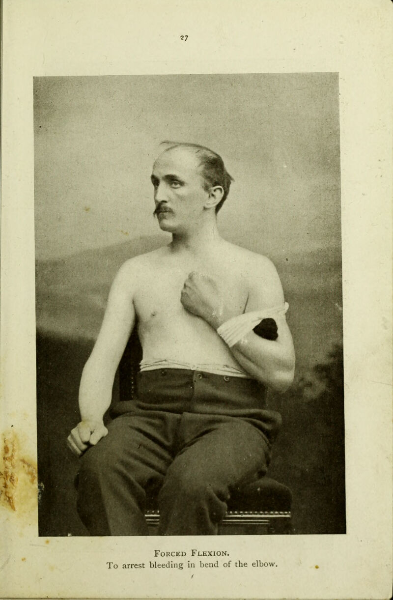 Forced Flexion. To arrest bleeding in bend of the elbow.