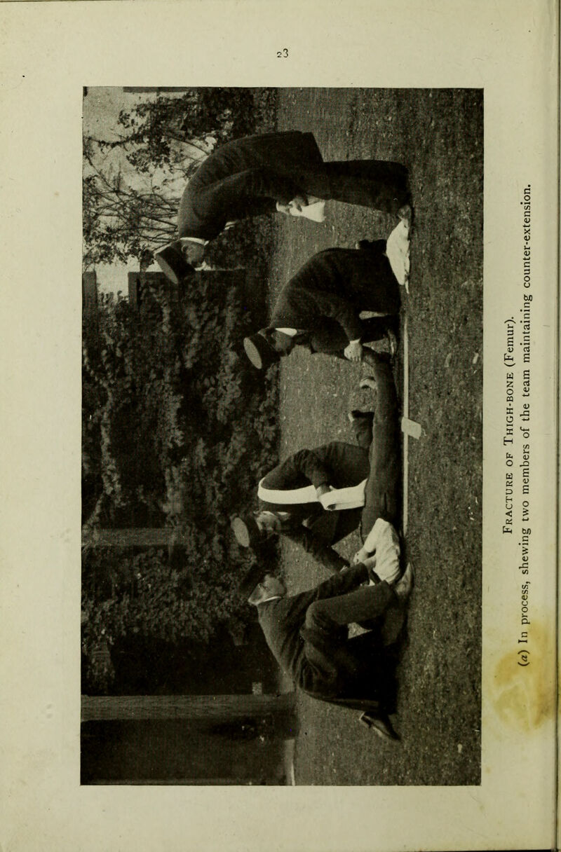 23 Fracture of Thigh-bone (Femur).