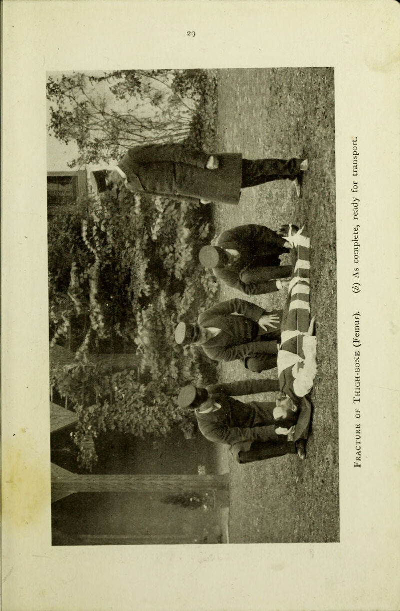 Fracture of Thigh-bone (Femur). (b) As complete, ready for transport.