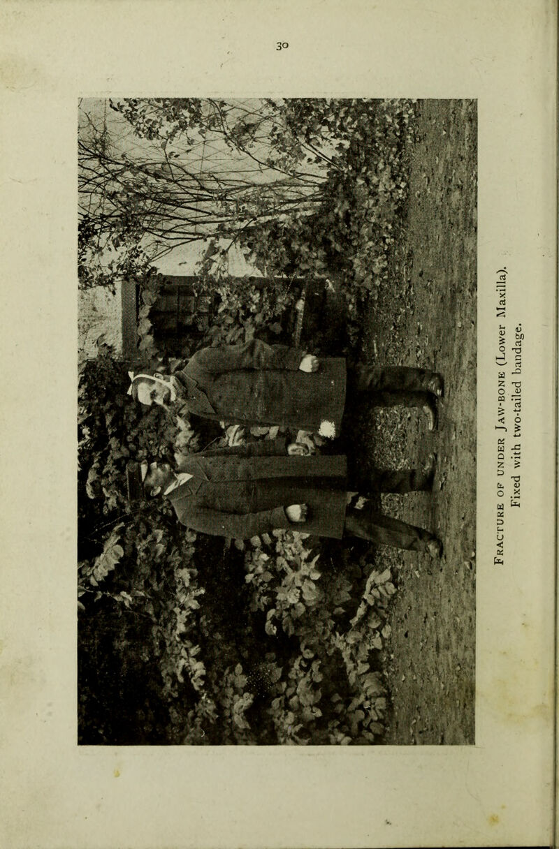 Fracture of under Jaw-bone (Lower Maxilla). Fixed with two-tailed bandage.