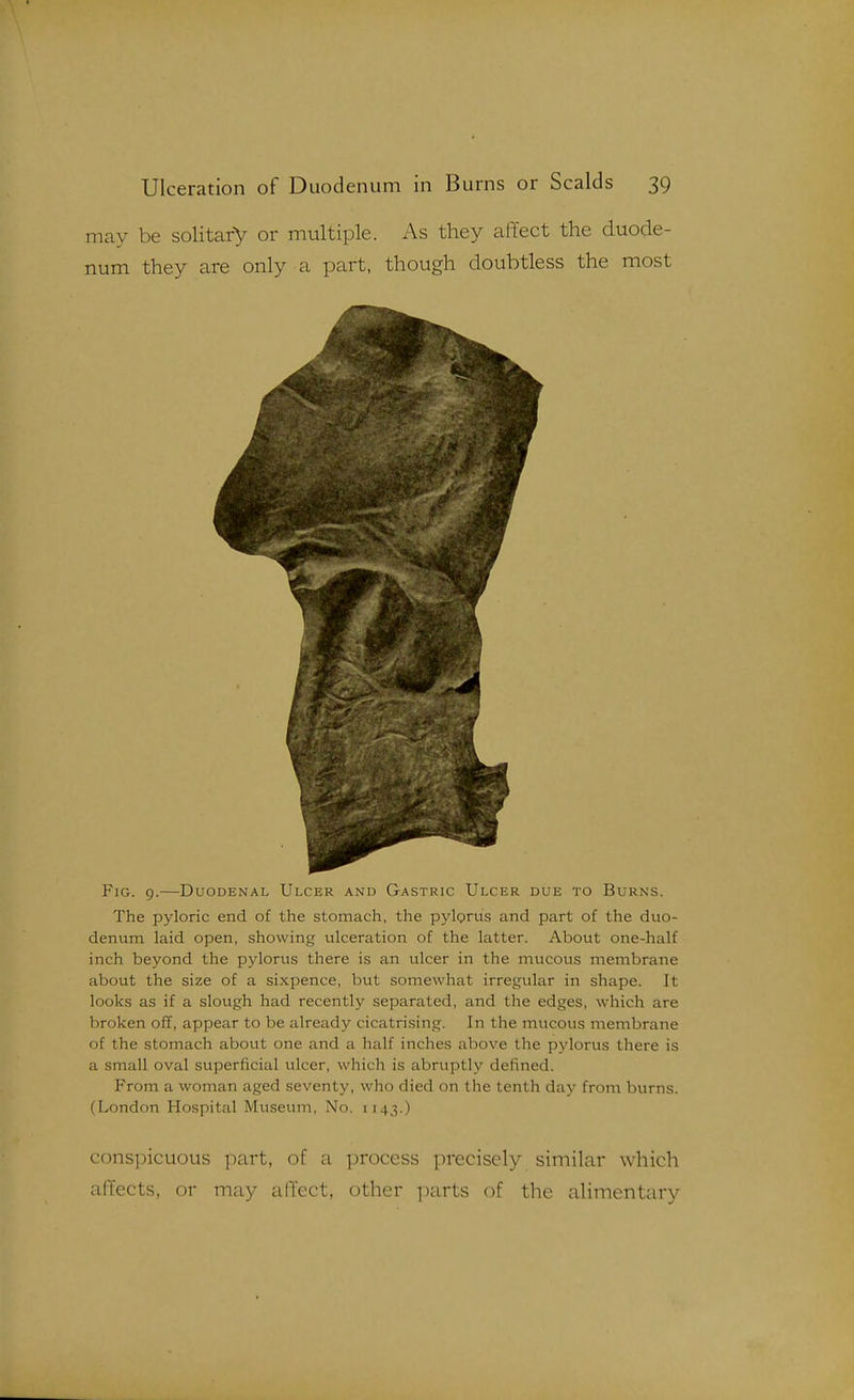 may be solitary or multiple. As they affect the duocle- num they are only a part, though doubtless the most Fig. 9.—Duodenal Ulcer and Gastric Ulcer due to Burns. The pyloric end of the stomach, the pylprus and part of the duo- denum laid open, showing ulceration of the latter. About one-half inch beyond the pylorus there is an ulcer in the mucous membrane about the size of a sixpence, but somewhat irregular in shape. It looks as if a slough had recently separated, and the edges, which are broken off, appear to be already cicatrising. In the mucous membrane of the stomach about one and a half inches above the pylorus there is a small oval superficial ulcer, which is abruptly defined. From a woman aged seventy, who died on the tenth day from burns. (London Hospital Museum, No. 1143.) conspicuous part, of a process precisely similar which affects, or may affect, other ]xirts of the alimentary