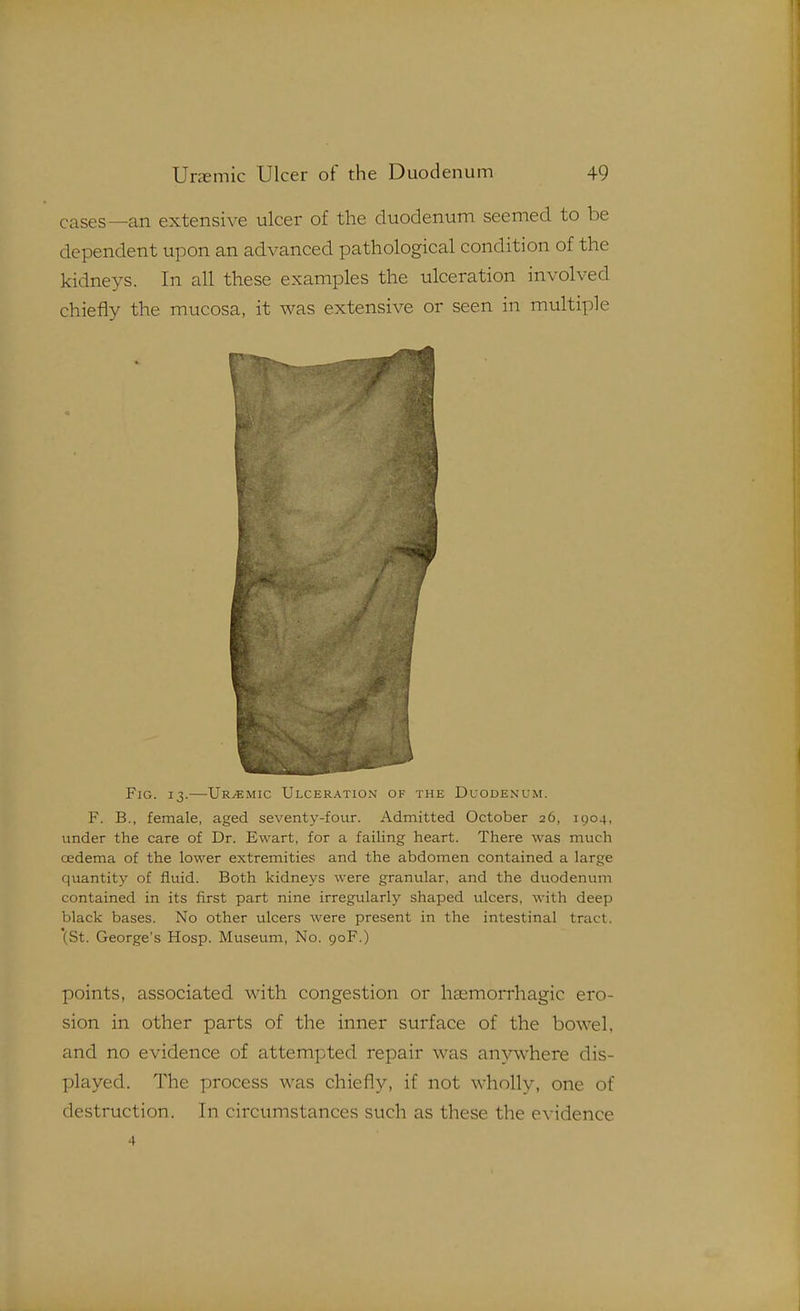 cases—an extensive ulcer of the duodenum seemed to be dependent upon an advanced pathological condition of the kidne3^s. In all these examples the ulceration involved chiefly the mucosa, it was extensive or seen in multiple Fig. 13.—Ur/emic Ulceration of the Duodenum. F. B., female, aged seventy-four. Admitted October 26, 1904, under the care of Dr. Ewart, for a failing heart. There was much cedema of the lower extremities and the abdomen contained a large quantity of fluid. Both kidneys were granular, and the dttodenum contained in its first part nine irregularly shaped ulcers, with deep black bases. No other ulcers were present in the intestinal tract. (St. George's Hosp. Museum, No. 90F.) points, associated with congestion or ha^morrhagic ero- sion in other parts of the inner surface of the bowel, and no evidence of attempted repair was anywhere dis- played. The process was chiefly, if not wholly, one of destruction. In circumstances such as these the evidence 4