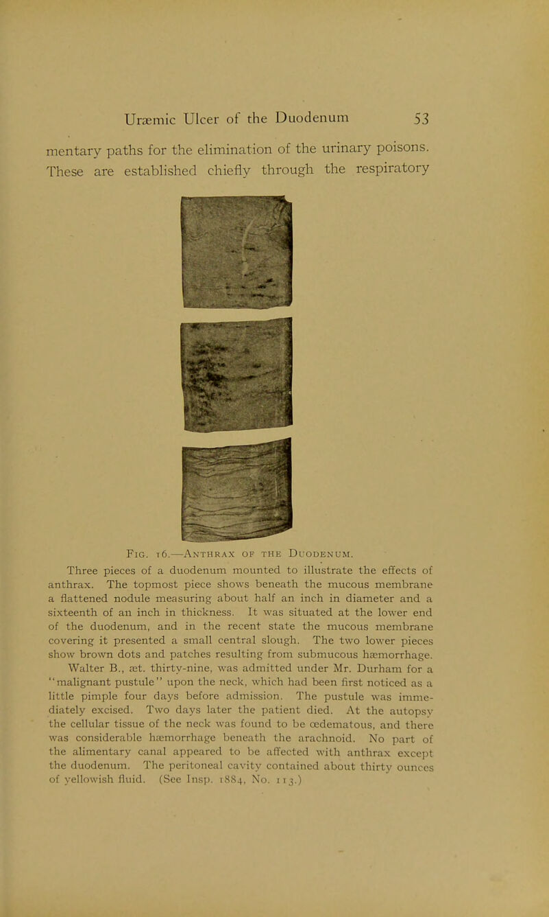 mentary paths for the eHmination of the urinary poisons. These are established chiefly through the respiratory Fig. t6.—Anthrax of the Duodenum. Three pieces of a duodenum mounted to illustrate the effects of anthrax. The topmost piece shows beneath the mucous membrane a flattened nodule measuring about half an inch in diameter and a sixteenth of an inch in thickness. It was situated at the lower end of the duodenum, and in the recent state the mucous membrane covering it presented a small central slough. The two lower pieces show brown dots and patches resulting from submucous haemorrhage. Walter B., fet. thirty-nine, was admitted under Mr. Durham for a malignant pustule upon the neck, which had been first noticed as a little pimple four days before admission. The pustule was imme- diately excised. Two days later the patient died. At the autopsy the cellular tissue of the neck was found to be oedematous, and there was considerable haemorrhage beneath the arachnoid. No part of the alimentary canal appeared to be affected with anthrax except the duodenum. The peritoneal cavity contained about thirty ounces of yellowish fluid. (See Insp. 1884, No. 113.)