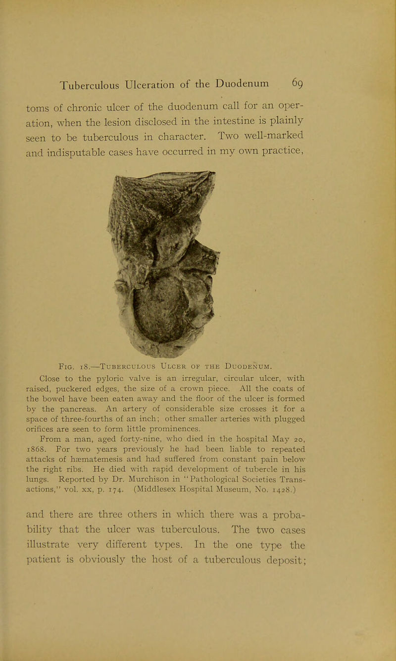 toms of chronic ulcer of the duodenum call for an oper- ation, when the lesion disclosed in the intestine is plainly seen to be tuberculous in character. Two well-marked and indisputable cases have occurred in my own practice, Fig. 18.—Tuberculous Ulcer of the Duodenum. Close to the pyloric valve is an irregular, circular ulcer, with raised, puckered edges, the size of a crown piece. All the coats of the bowel have been eaten away and the floor of the ulcer is formed by the pancreas. An artery of considerable size crosses it for a space of three-fourths of an inch; other smaller arteries with plugged orifices are seen to form little prominences. From a man, aged forty-nine, who died in the hospital May 20, 1868. For two years previously he had been liable to repeated attacks of hsematemesis and had suffered from constant pain below the right ribs. He died with rapid development of tubercle in his lungs. Reported by Dr. Murchison in Pathological Societies Trans- actions, vol. XX, p. 174. (Middlesex Hospital Museum, No. 142S.) and there are three others in which there was a proba- bility that the ulcer was tuberculous. The two cases illustrate very different types. In the one type the patient is obviously the host of a tuberculous deposit;