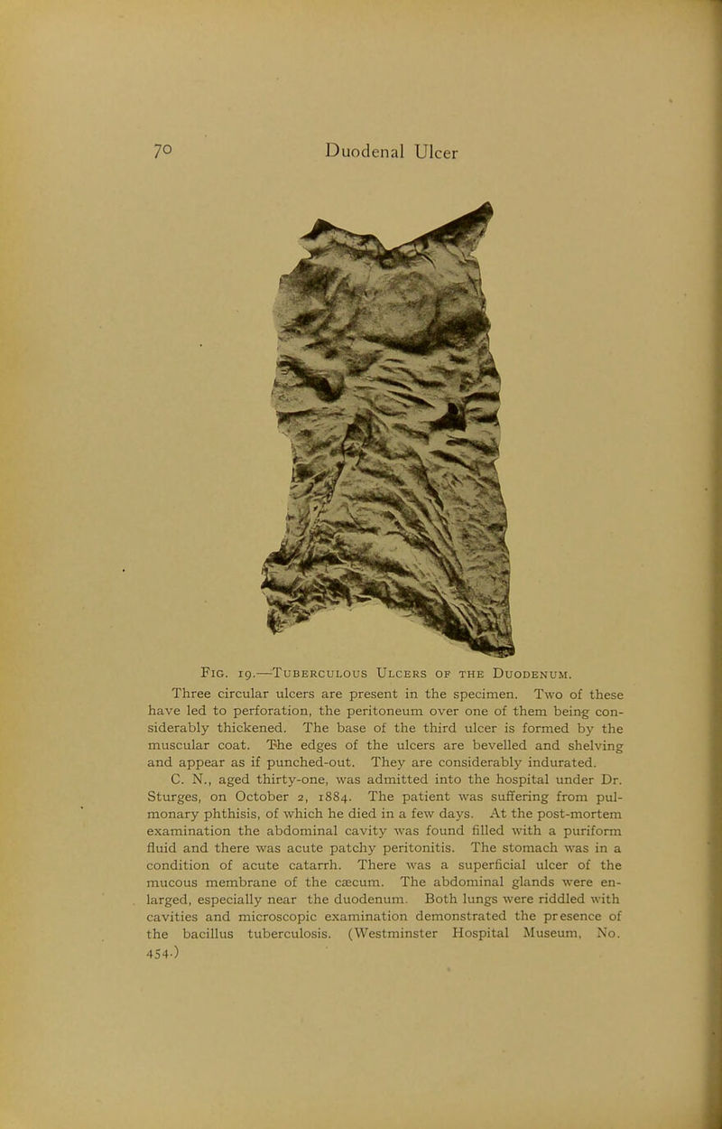 Fig. 19.—^Tuberculous Ulcers of the Duodenum. Three circular ulcers are present in the specimen. Two of these have led to perforation, the peritoneum over one of them being con- siderably thickened. The base of the third ulcer is formed by the muscular coat. The edges of the ulcers are bevelled and shelving and appear as if punched-out. They are considerably indurated. C. N., aged thirty-one, was admitted into the hospital under Dr. Sturges, on October 2, 1884. The patient was suffering from pul- monary phthisis, of which he died in a few days. At the post-mortem examination the abdominal cavity was found filled with a puriform fluid and there was acute patchy peritonitis. The stomach was in a condition of acute catarrh. There was a superficial ulcer of the mucous membrane of the caecum. The abdominal glands were en- larged, especially near the duodenum. Both lungs were riddled with cavities and microscopic examination demonstrated the presence of the bacillus tuberculosis. (Westminster Hospital Museum, No. 454-)