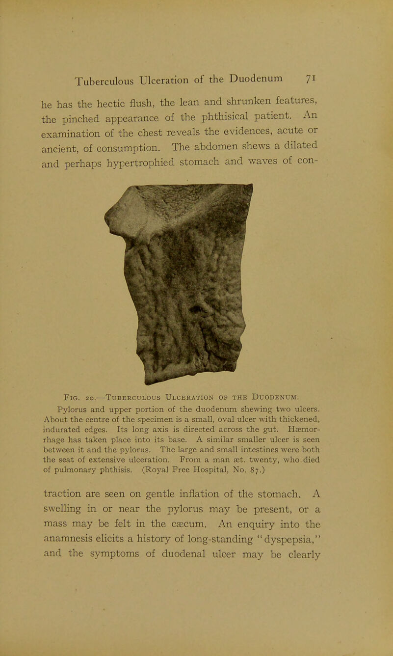 he has the hectic flush, the lean and shrunken features, the pinched appearance of the phthisical patient. An examination of the chest reveals the evidences, acute or ancient, of consumption. The abdomen shews a dilated and perhaps hypertrophied stomach and waves of con- FiG. 20.—Tuberculous Ulceration of the Duodenum. Pylorus and upper portion of the duodenum shewing two ulcers. About the centre of the specimen is a small, oval ulcer with thickened, indurated edges. Its long axis is directed across the gut. Haemor- rhage has taken place into its base. A similar smaller ulcer is seen between it and the pylorus. The large and small intestines were both the seat of extensive ulceration. From a man ast. twenty, who. died of pulmonary phthisis. (Royal Free Hospital, No. 87.) traction are seen on gentle inflation of the stomach. A swelling in or near the pylorus may be present, or a mass may be felt in the caecum. An enquiry into the anamnesis elicits a history of long-standing dyspepsia, and the symptoms of duodenal ulcer may be clearly