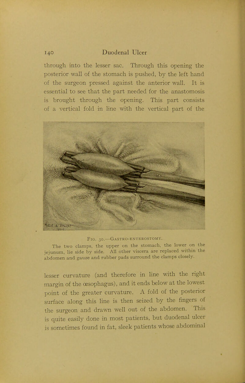 through into the lesser sac. Through this opening the posterior wall of the stomach is pushed, by the left hand of the surgeon pressed against the anterior wall. It is essential to see that the part needed for the anastomosis is brought through the opening. This part consists of a vertical fold in line with the vertical part of the U-.u: i_lB.og., Fig. 30.—Gastro-enterostomy. The two clamps, the upper on the stomach, the lower on the jejunum, lie side by side. All other viscera are replaced within the abdomen and gauze and rubber pads surround the clamps closely. lesser curvature (and therefore in line with the right margin of the oesophagus), and it ends below at the lowest point of the greater curvature. A fold of the posterior surface along this line is then seized by the fingers of the surgeon and drawn well out of the abdomen. This is quite easily done in most patients, but duodenal ulcer is sometimes found in fat, sleek patients whose abdominal