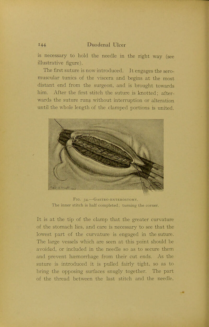 is necessary to hold the needle in the right way (see illustrative figure). The first suture is now introduced. It engages the sero- muscular tunics of the viscera and begins at the most distant end from the surgeon, and is brought towards him. After the first stitch the suture is knotted; after- wards the suture runs without interruption or alteration until the whole length of the clamped portions is united. \ A- Fig. 34.—Gastro-enterostomy. The inner stitch is half completed; turning the comer. It is at the tip of the clamp that the greater curvature of the stomach lies, and care is necessary to see that the lowest part of the curvature is engaged in the suture. The large vessels which are seen at this point should be avoided, or included in the needle so as to secure them and prevent hsemorrhage from their cut ends. As the suture is introduced it is pulled fairly tight, so as to bring the opposing surfaces snugly together. The part of the thread between the last stitch and the needle,