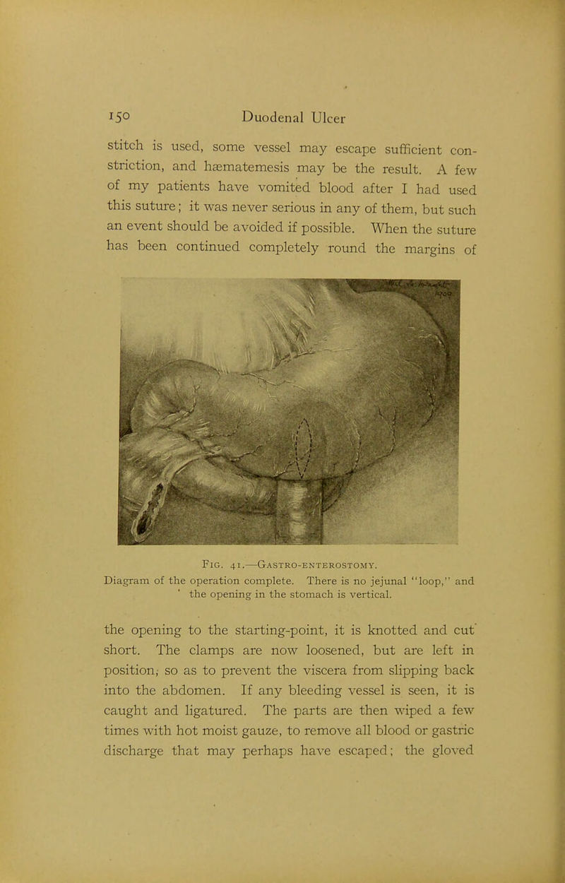 stitch is used, some vessel may escape sufficient con- striction, and hffimatemesis may be the result. A few of my patients have vomited blood after I had used this suture; it was never serious in any of them, but such an event should be avoided if possible. When the suture has been continued completely round the margins of 1 Fig. 41.—Gastro-enterostomy. Diagram of the operation complete. There is no jejunal loop, and the opening in the stomach is vertical. the opening to the starting-point, it is knotted and cut short. The clamps are now loosened, but are left in position,- so as to prevent the viscera from slipping back into the abdomen. If any bleeding vessel is seen, it is caught and ligatured. The parts are then wiped a few times with hot moist gauze, to remove all blood or gastric discharge that may perhaps have escaped; the gloved
