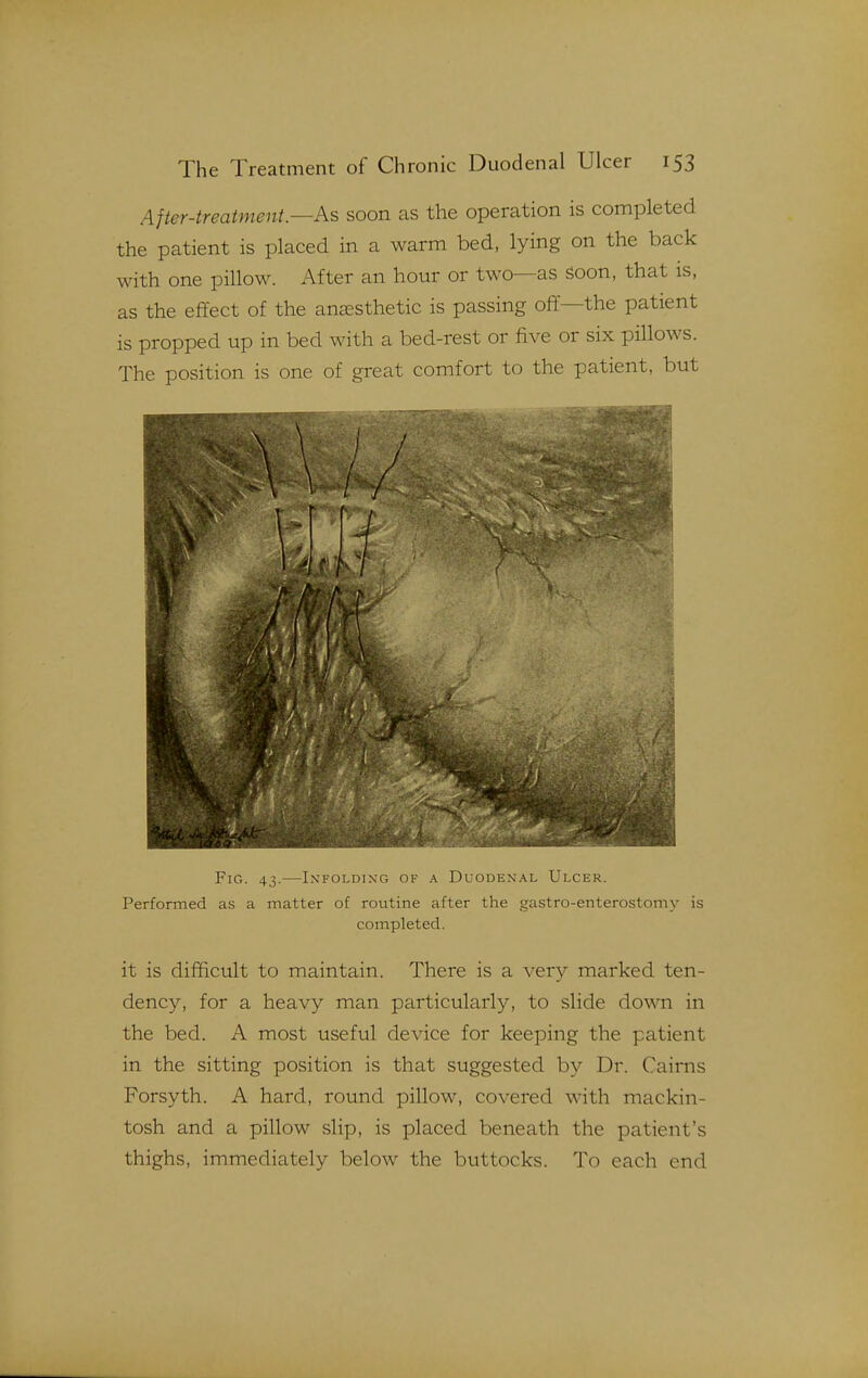 After-treatment.—As soon as the operation is completed the patient is placed in a warm bed, lying on the back with one pillow. After an hour or two—as soon, that is, as the effect of the anesthetic is passing off—the patient is propped up in bed with a bed-rest or five or six pillows. The position is one of great comfort to the patient, but Fig. 43.—Infolding of a Duoden.\l Ulcer. Performed as a matter of routine after the gastro-enterostomy is completed. it is difficult to maintain. There is a very marked ten- dency, for a heavy man particularly, to slide down in the bed. A most useful device for keeping the patient in the sitting position is that suggested by Dr. Cairns Forsyth. A hard, round pillow, covered with mackin- tosh and a pillow slip, is placed beneath the patient's thighs, immediately below the buttocks. To each end