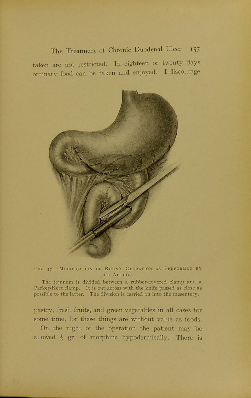 taken are not restricted. In eighteen or twenty days ordinary food can be taken and enjoyed. I discourage Fig. 47.—Modification of Roux's Operation as Performed by THE Author. The jejunum is divided between a rubber-covered clamp and a Parker-Kerr clamp. It is cut across with the knife passed as close as possible to the latter. The division is carried on into the mesentery. pastry, fresh fruits, and green vegetables in all cases for some time, for these things are without value as foods. On the night of the operation the patient may be allowed ^ gr. of morphine hypodermically. There is