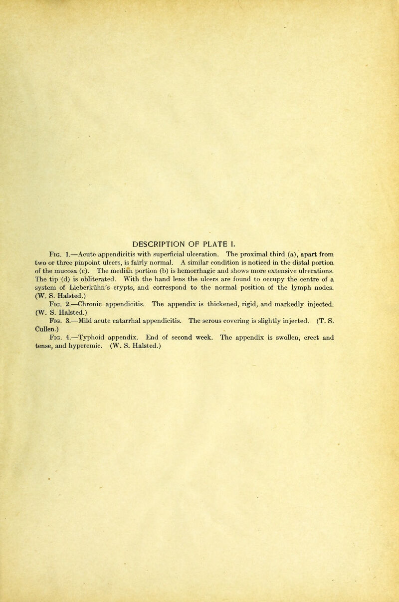 Fig. 1.—Acute appendicitis with superficial ulceration. The proximal third (a), apart from two or three pinpoint ulcers, is fairly normal. A similar condition is noticed in the distal portion of the mucosa (c). The median portion (b) is hemorrhagic and shows more extensive ulcerations. The tip (d) is obliterated. With the hand lens the ulcers are found to occupy the centre of a system of Lieberkiihn's crypts, and correspond to the normal position of the lymph nodes. (W. S. Halsted.) Fig. 2.—Chronic appendicitis. The appendix is thickened, rigid, and markedly injected. (W. S. Halsted.) Fig. 3.—Mild acute catarrhal appendicitis. The serous covering is slightly injected. (T. S. CuUen.) Fig. 4.—Typhoid appendix. End of second week. The appendix is swollen, erect and tense, and hyperemic. (W. S. Halsted.)